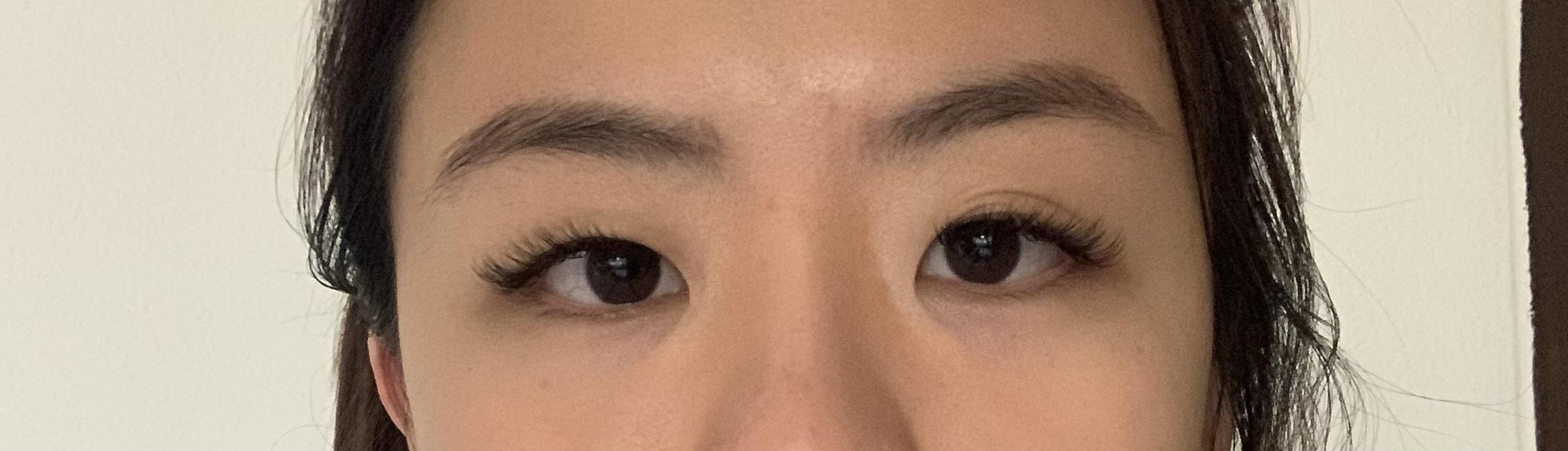 do i have (mild) ptosis? i get to claim insurance for double eyelid surgery if i have ptosis as