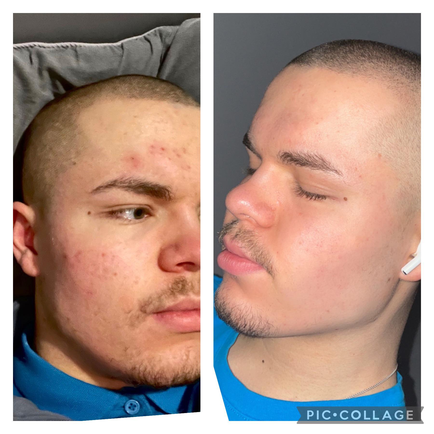 [B&A] Not a huge difference, but 6 months of 0.025 Tretinoin is