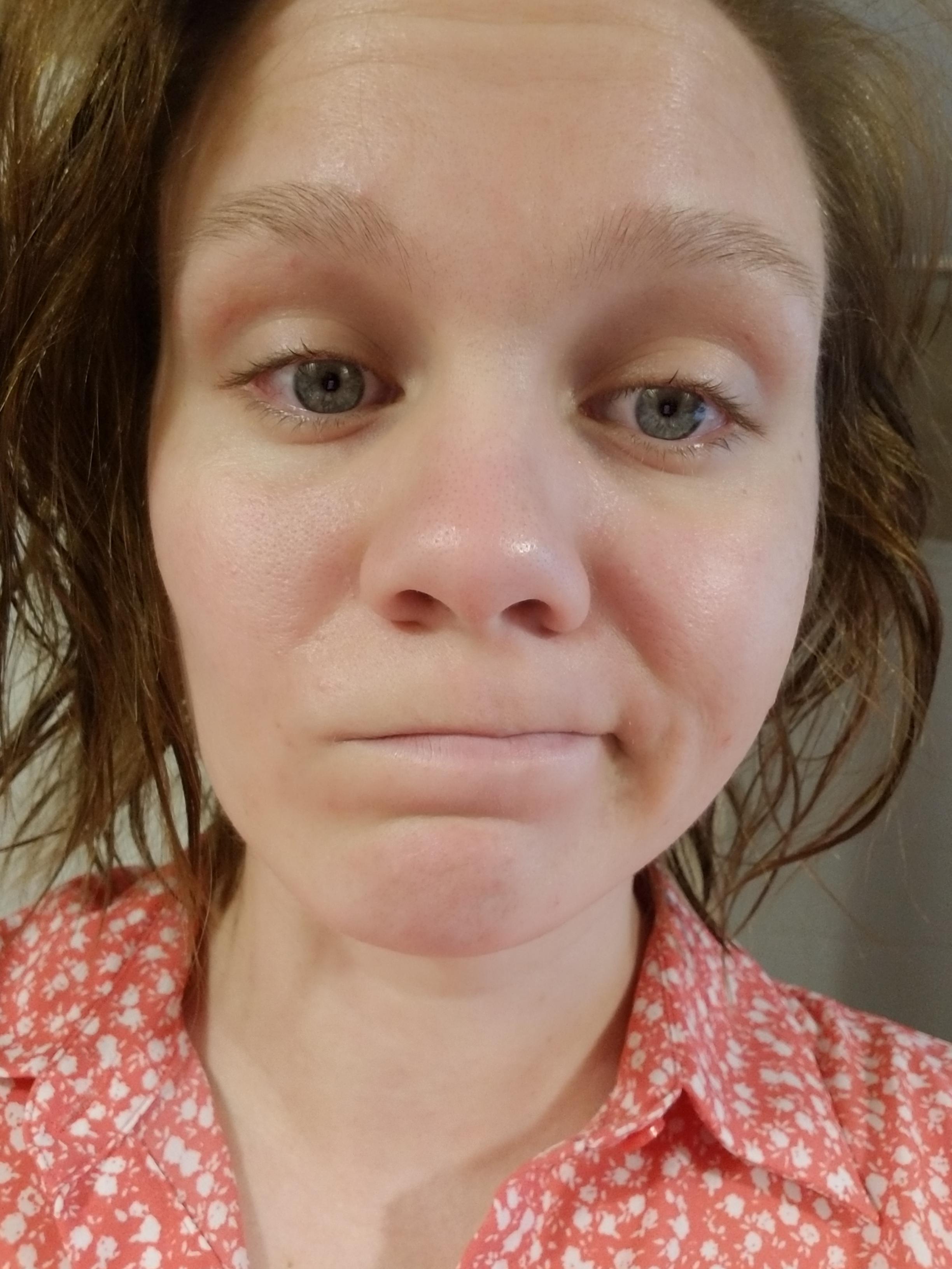 For years I thought my pink cheeks postshower was just a healthy glow