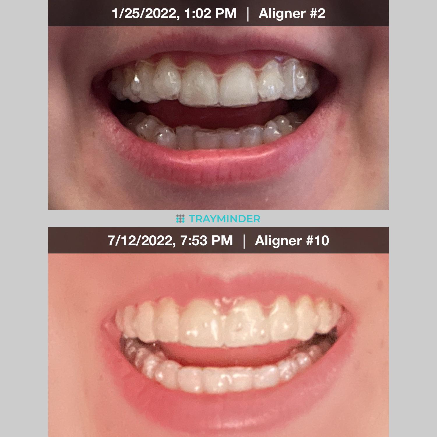 End of Aligner 1 to end of my first set of refinements! Invisalign