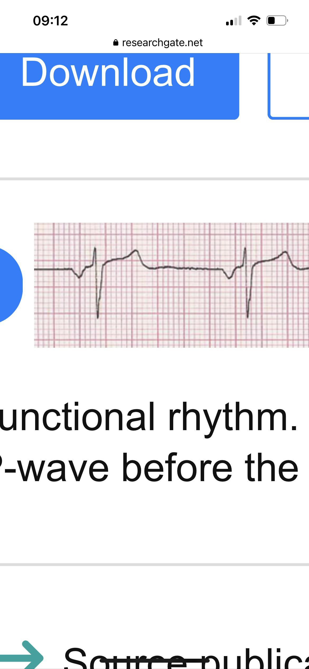 Normal Qrs Time