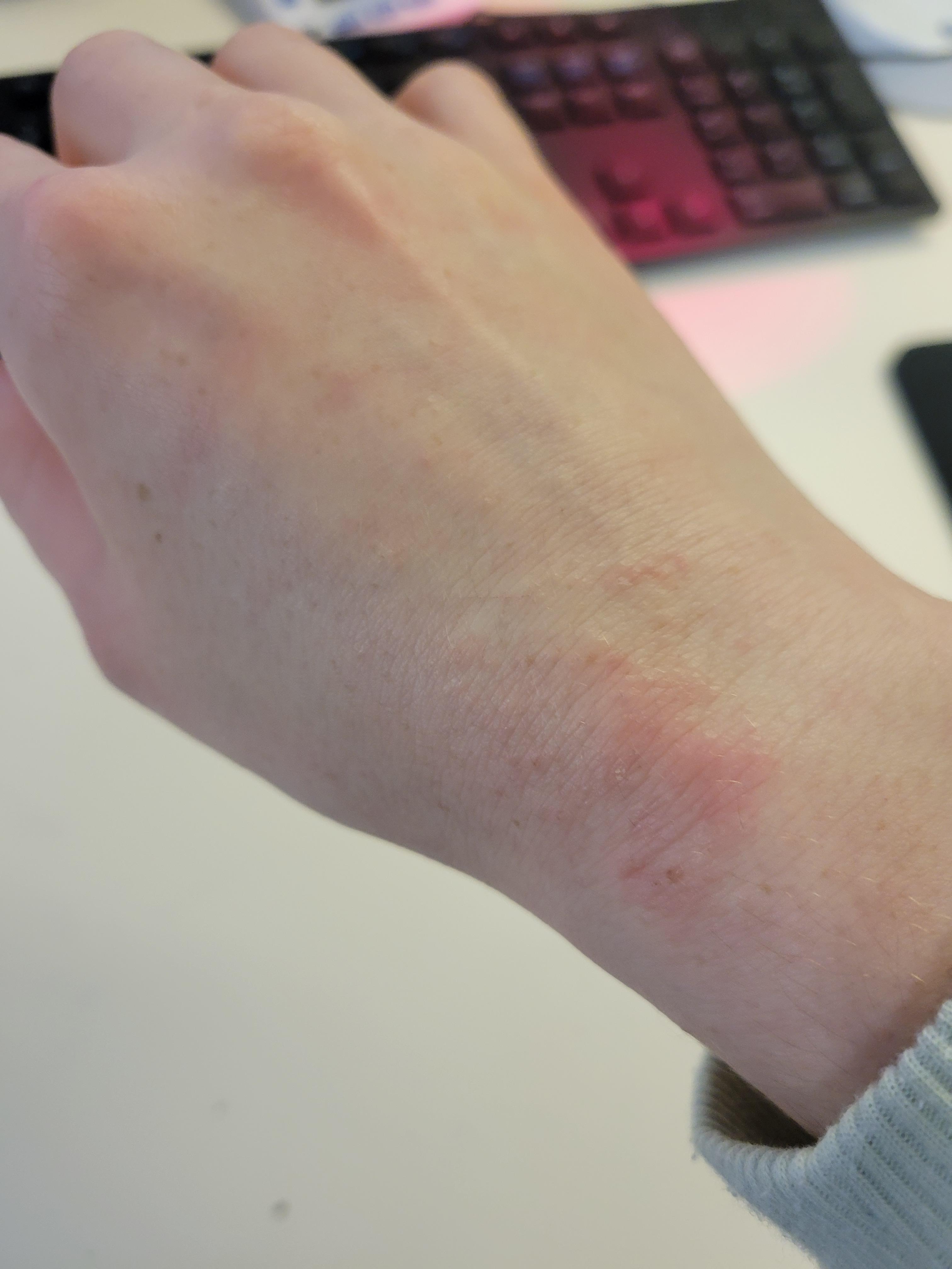 My gloves are causing painful eczema flareup on my wrists and knuckles