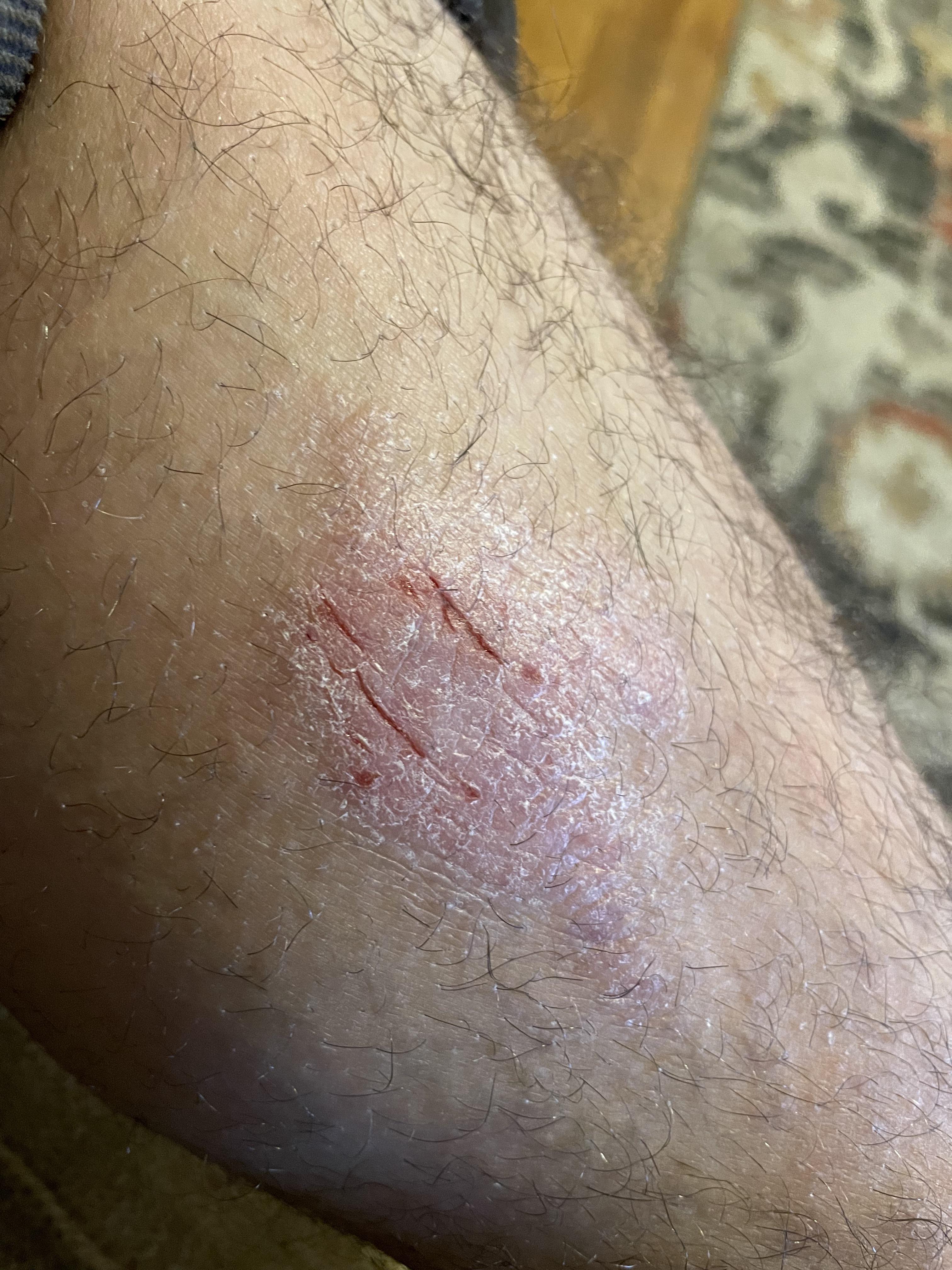 Eczema? Psoriasis? It’s been on my leg for years & def gets worse when my stomach/gastritis