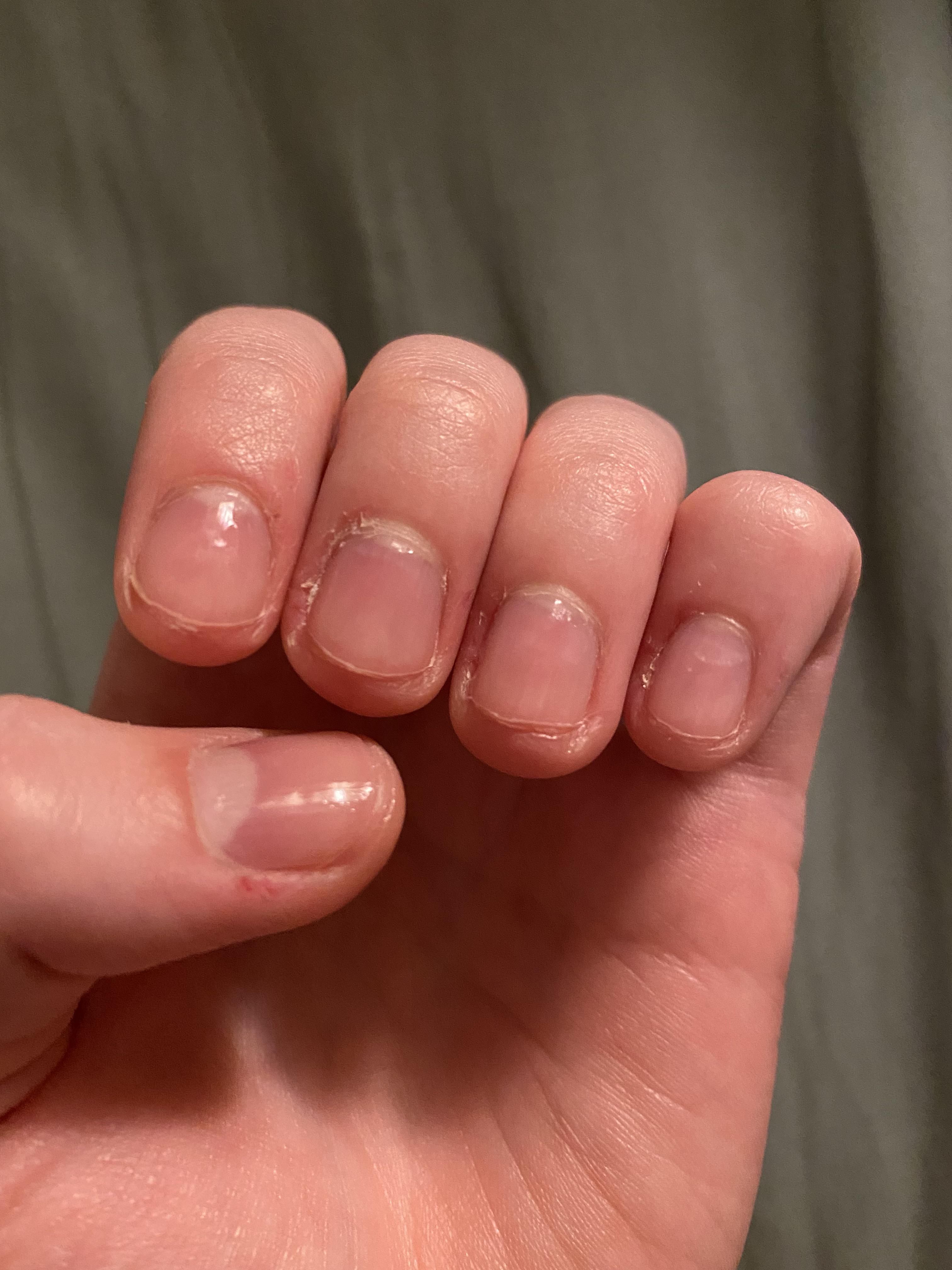 Bad compulsive habit ruining/pushing back nail beds( How can I stop