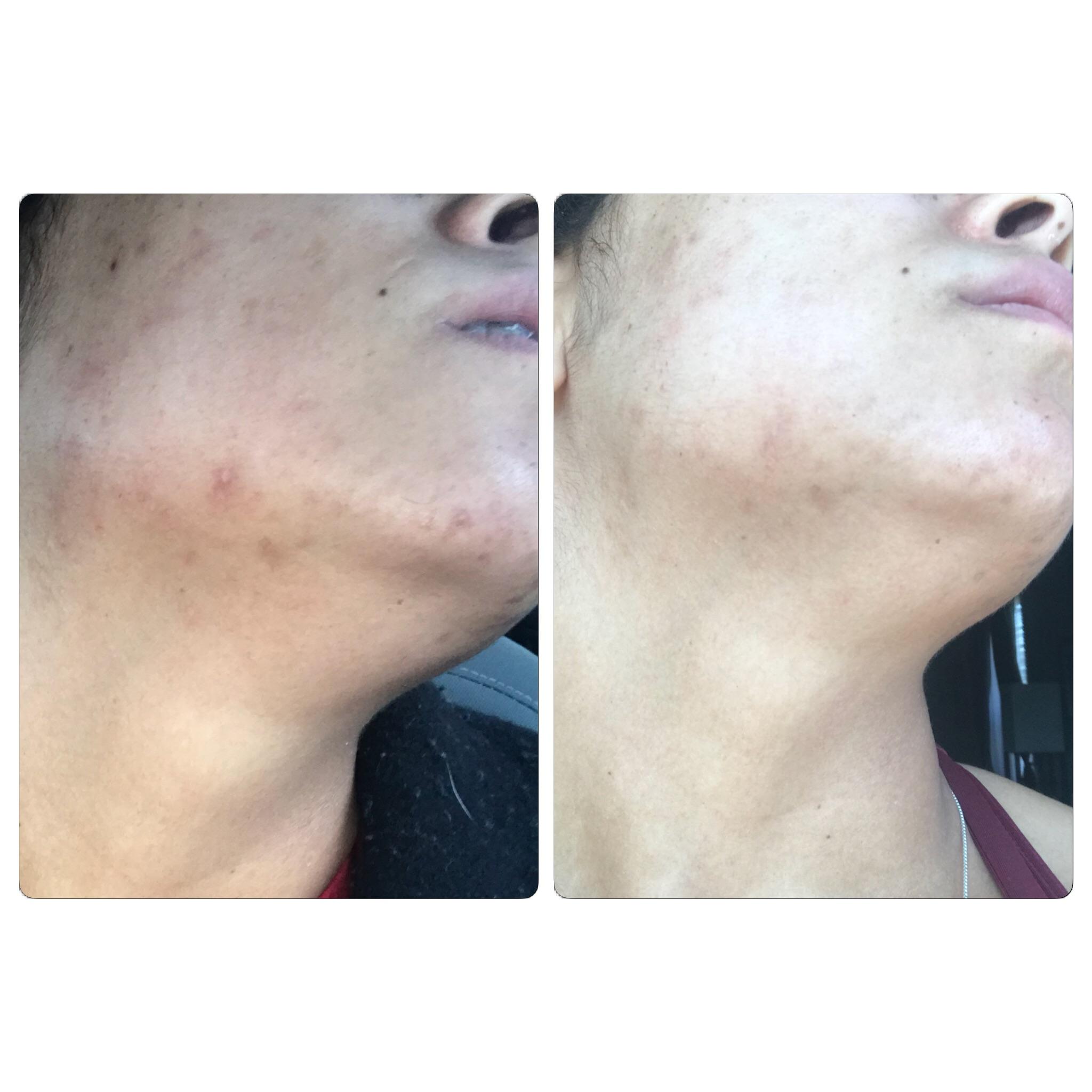 [b&a] 2 weeks of azelaic acid in the Am and yesto correct and repair