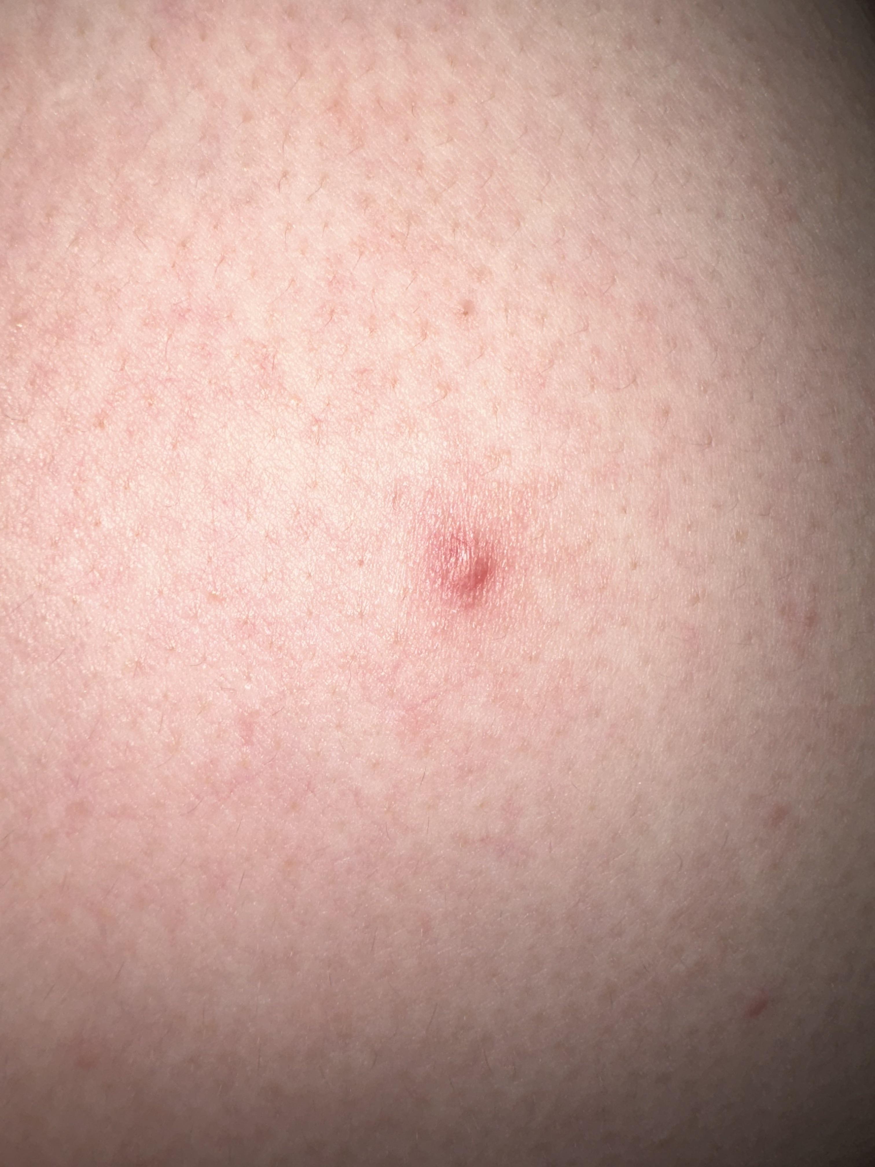 Is it a keloid or simply an acne scar? r/Keloids