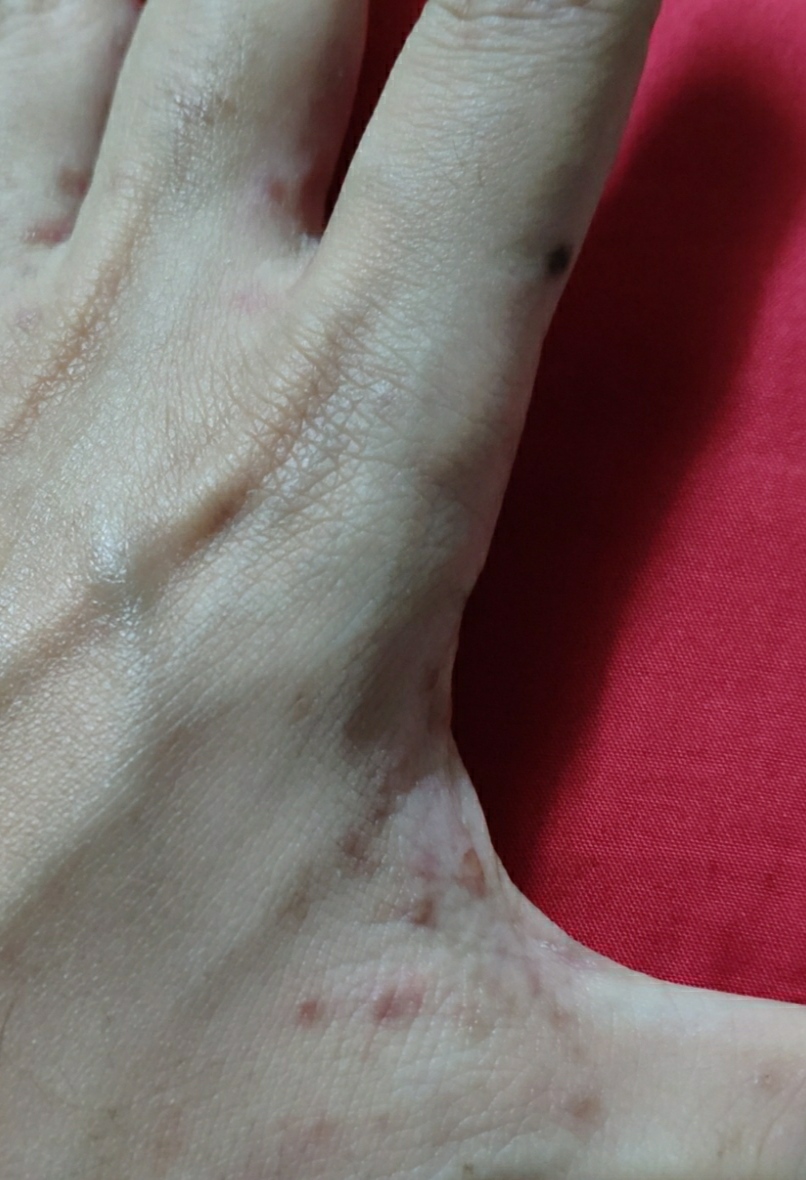 Are these scabies? I have them for 6 weeks. The blisters dry up then