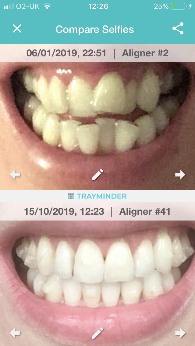 Aligner 2 compared to 41. Refinements needed, but already I'm thrilled with the results the