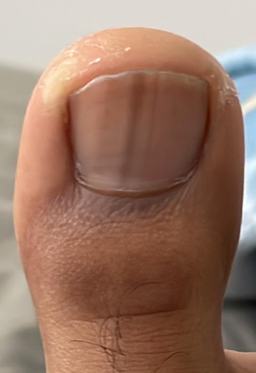 Dark vertical line on my toenail (also on my middle finger) r/Melanoma