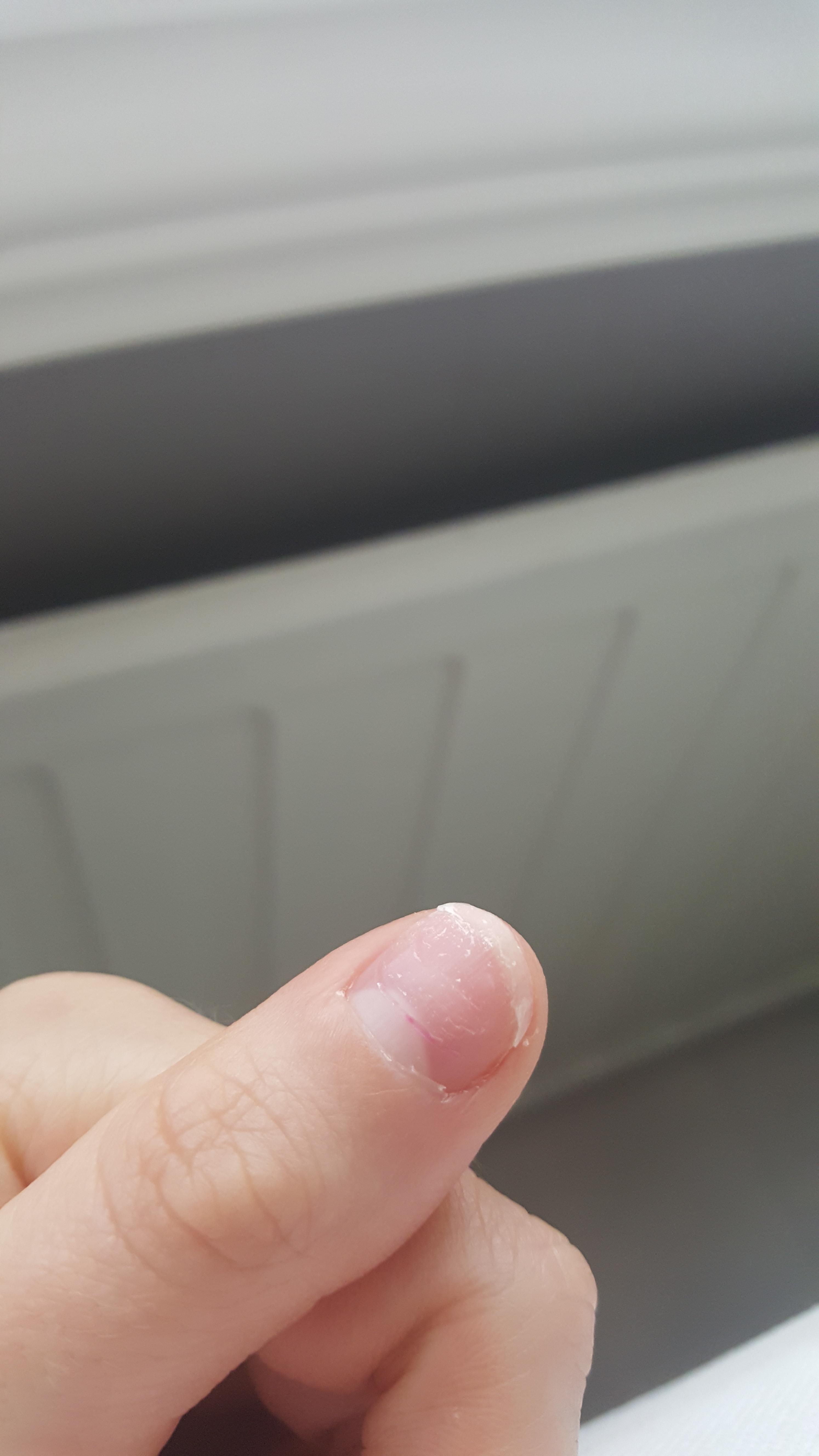 First time with acrylics. Severly damaged after getting them off after