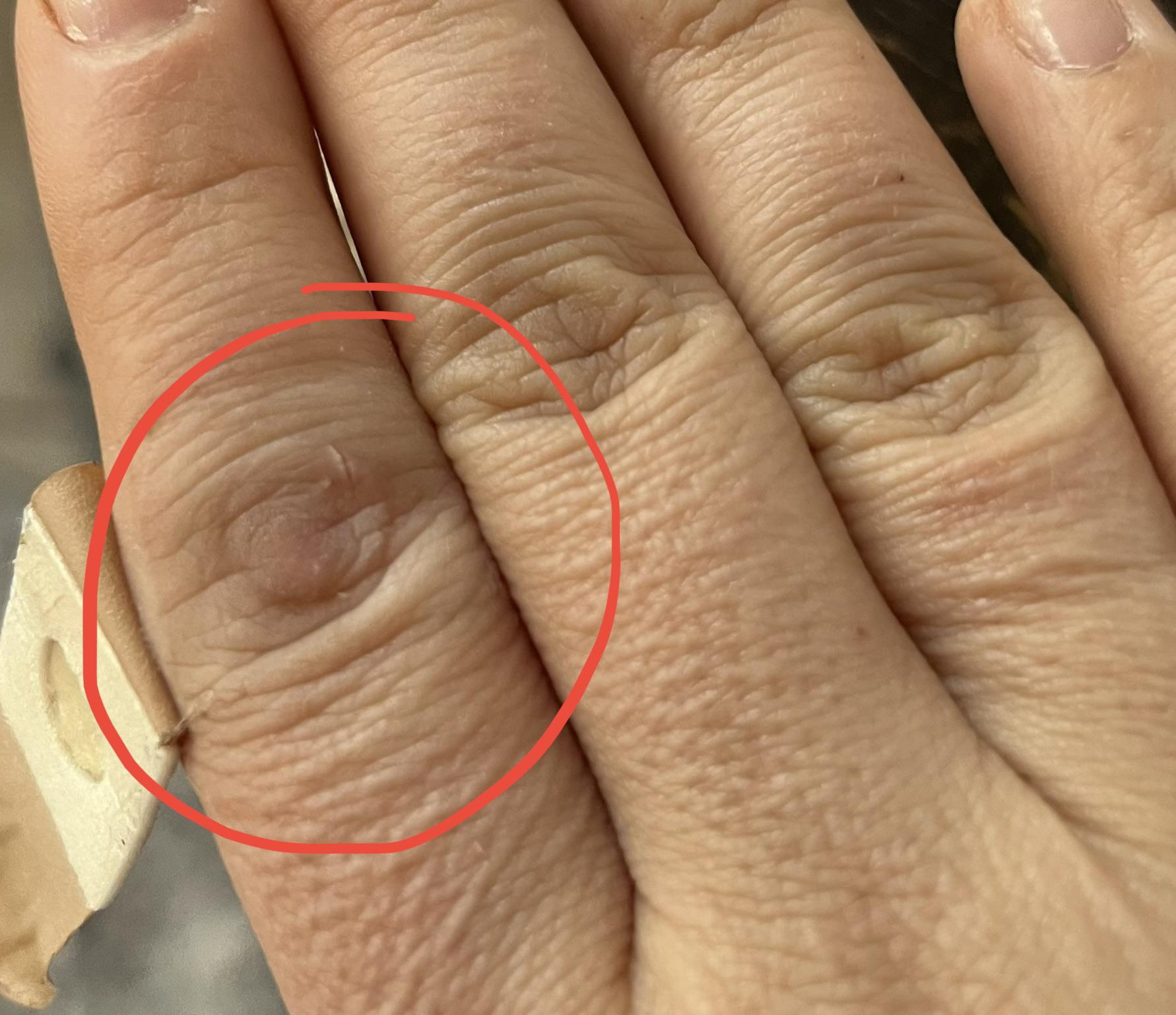 Is this a wart? I bought some wart removal bandages, but I’m not