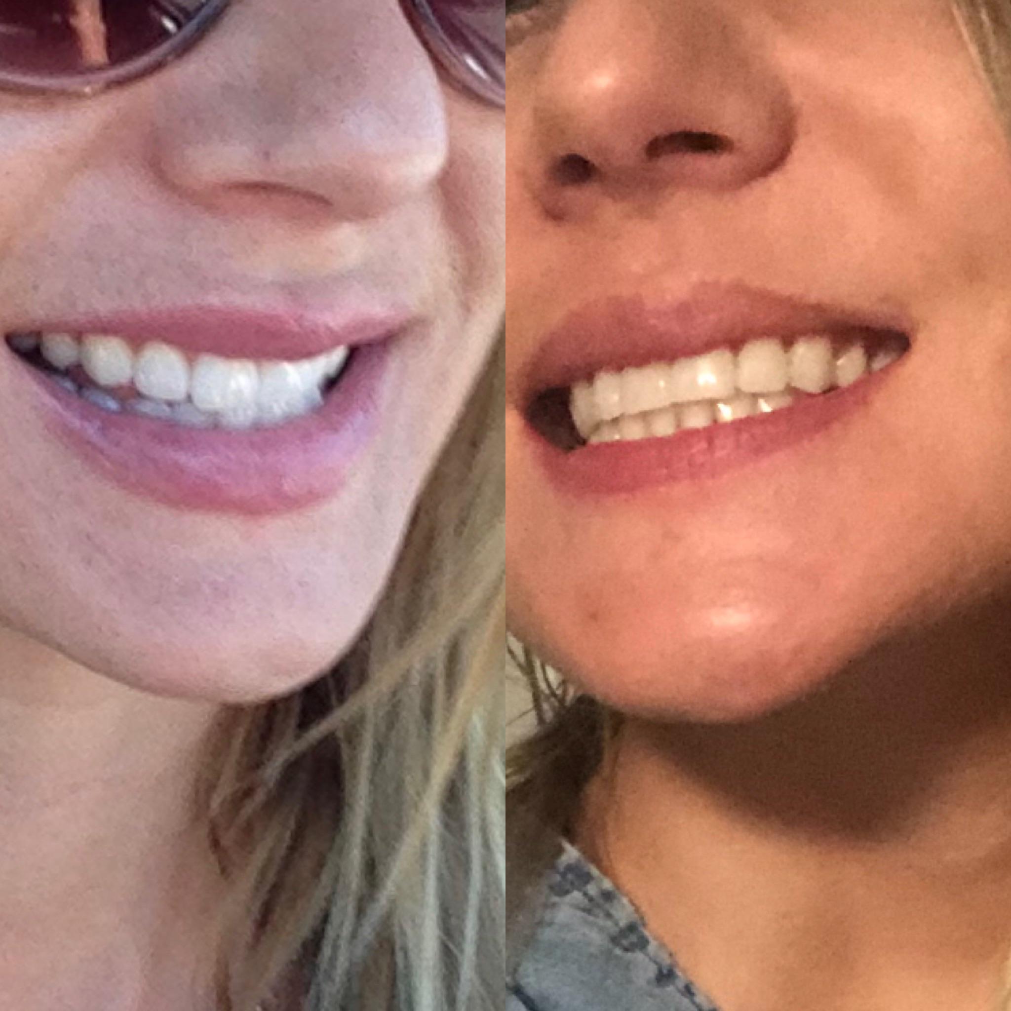 This is for those of you who have deep bite and Jutting lower jaw