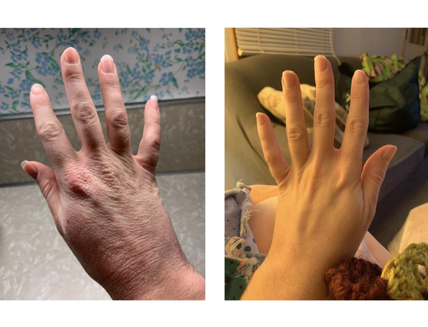 That transformation tho 😎 TW Dry hands!!!! r/OCD