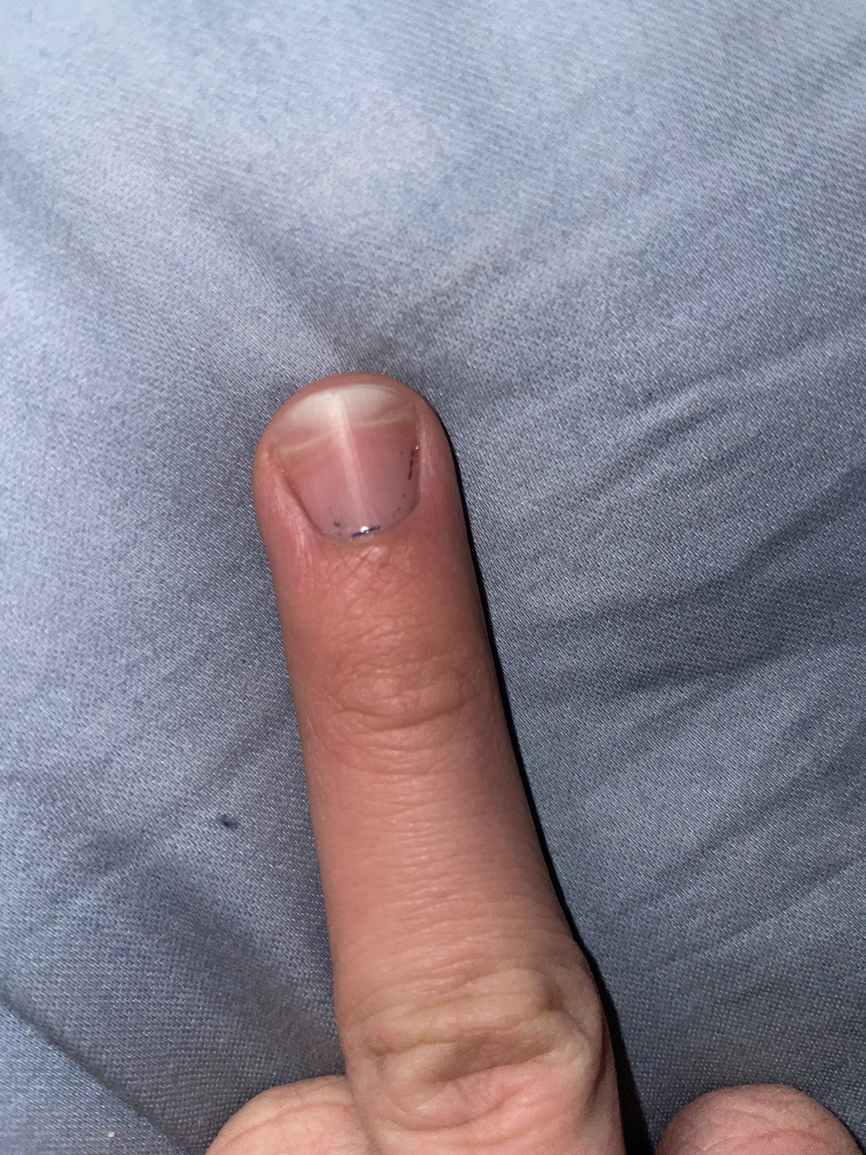 Do anyone else’s nail beds look like they are going to reattach only