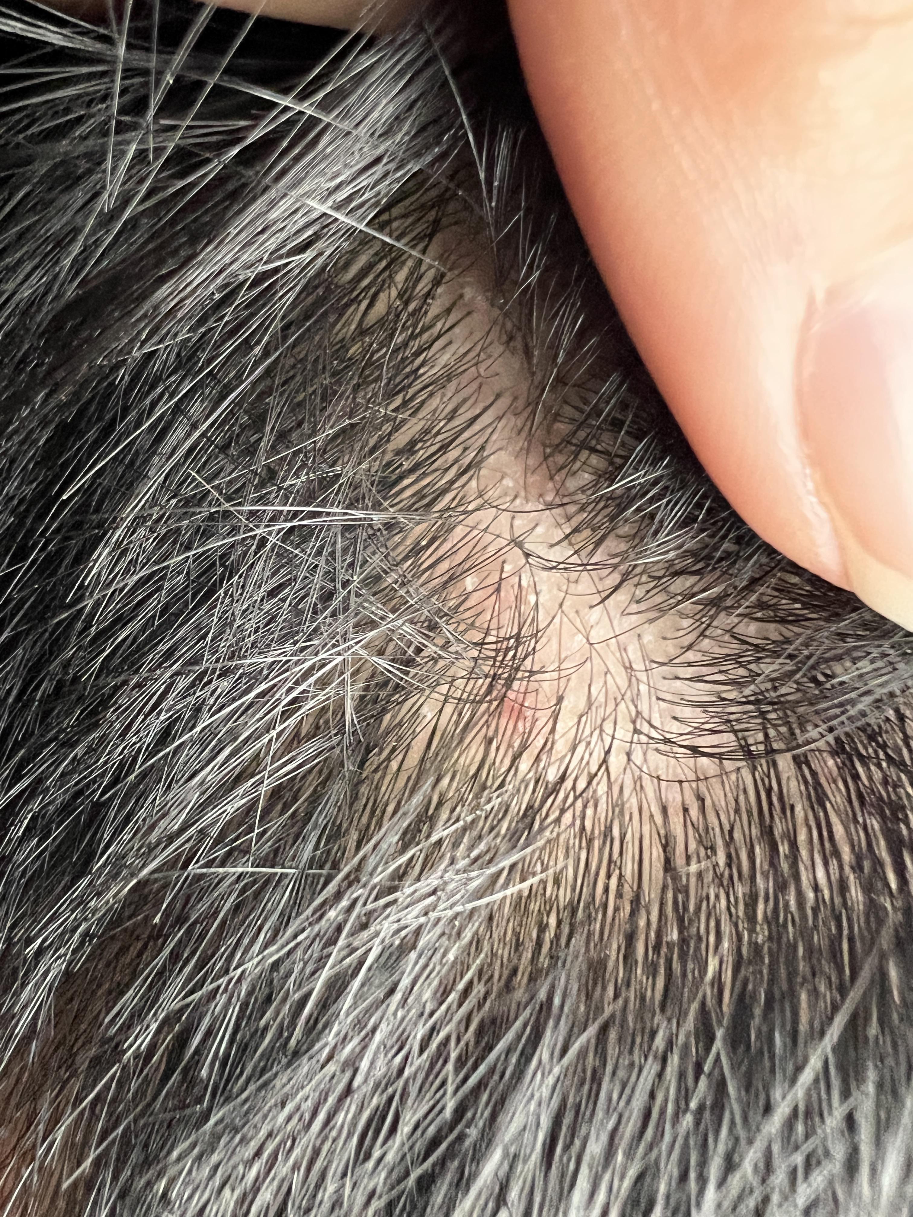 Lotta Lice or dry scalp? r/Lice