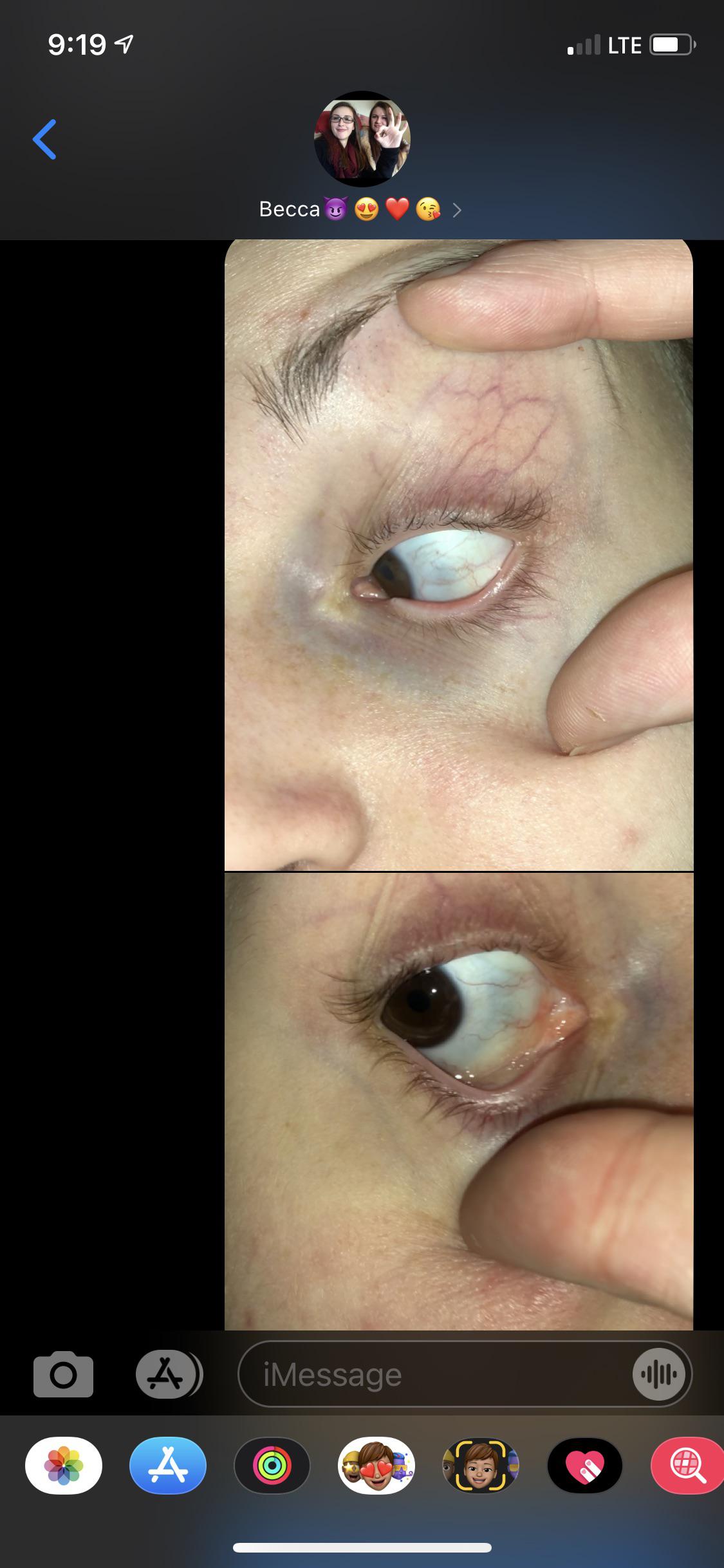 Grey sclera? Are my eyes ok? My vision has been getting worse. r