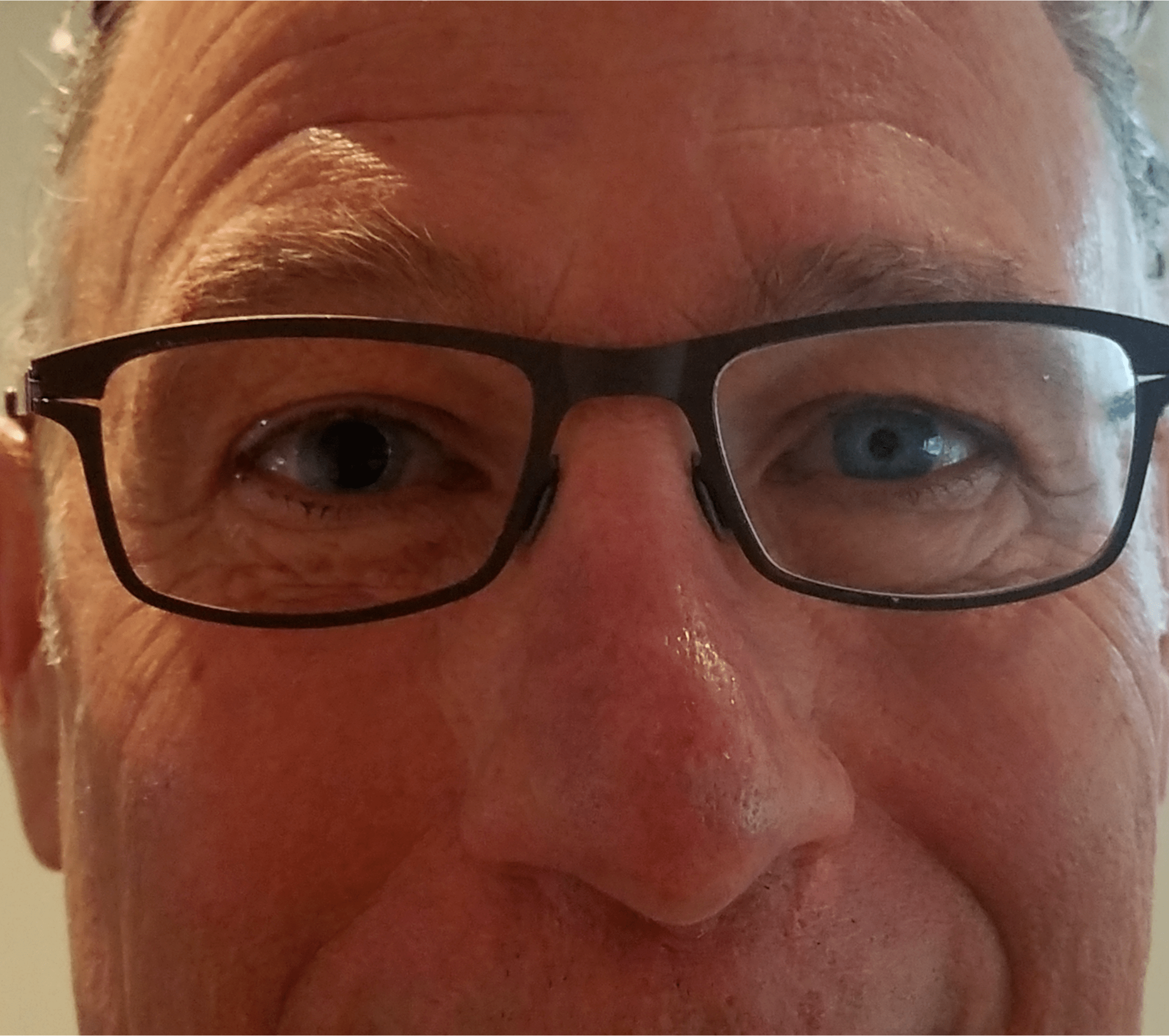 One of my dad's pupils is super dilated after cataract surgery r