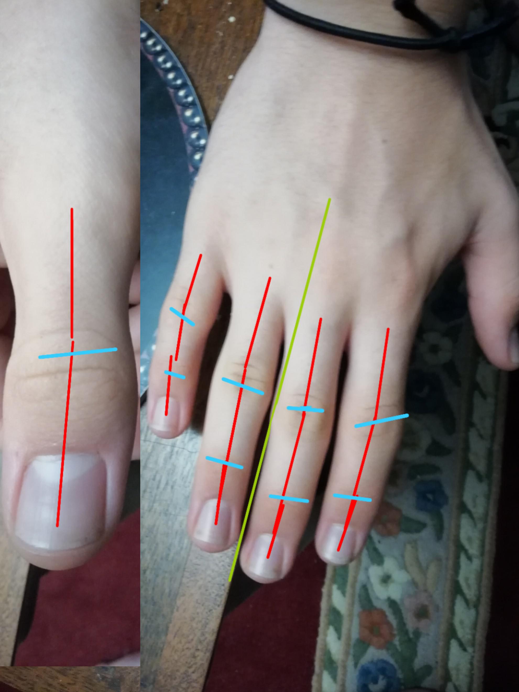 Why are my fingers crooked? i'm 14 y/o. this is something i'm very