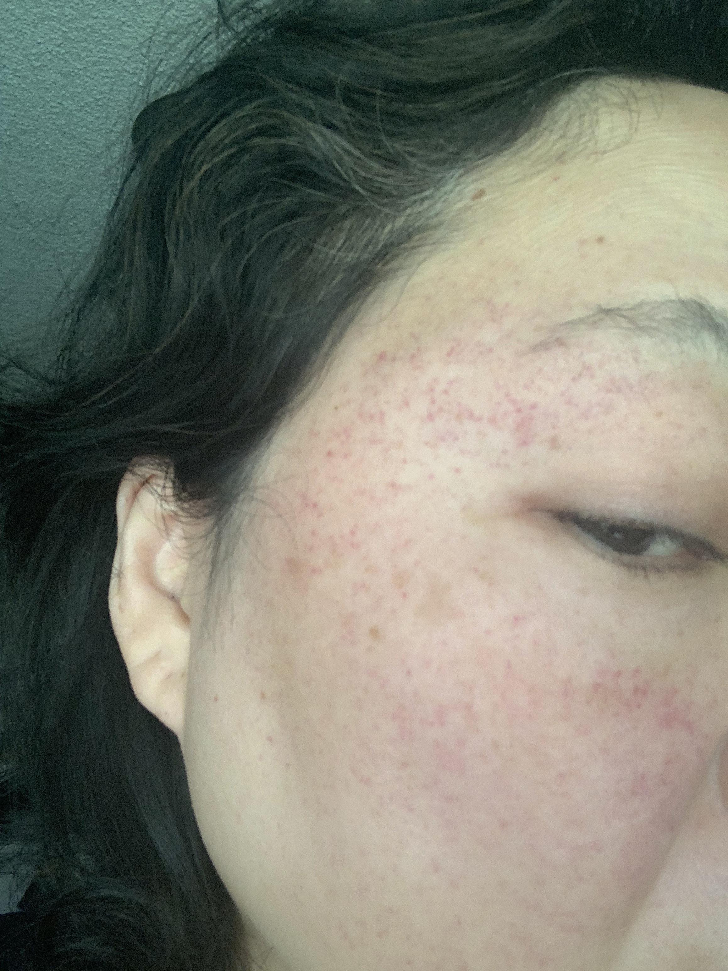 Petechiae all over face after surgery r/DermatologyQuestions