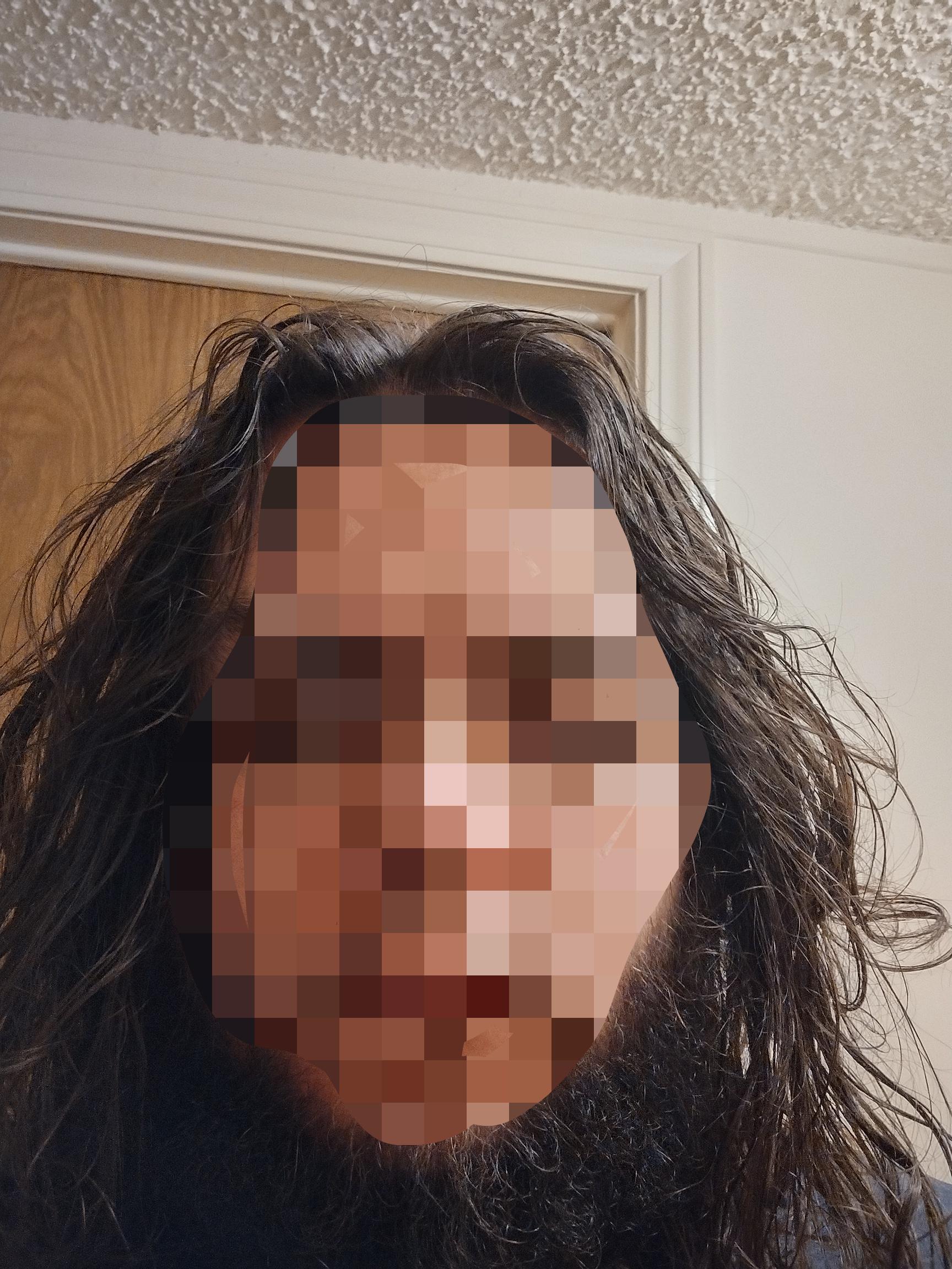 Would electrolysis or laser work best for permanently removing my