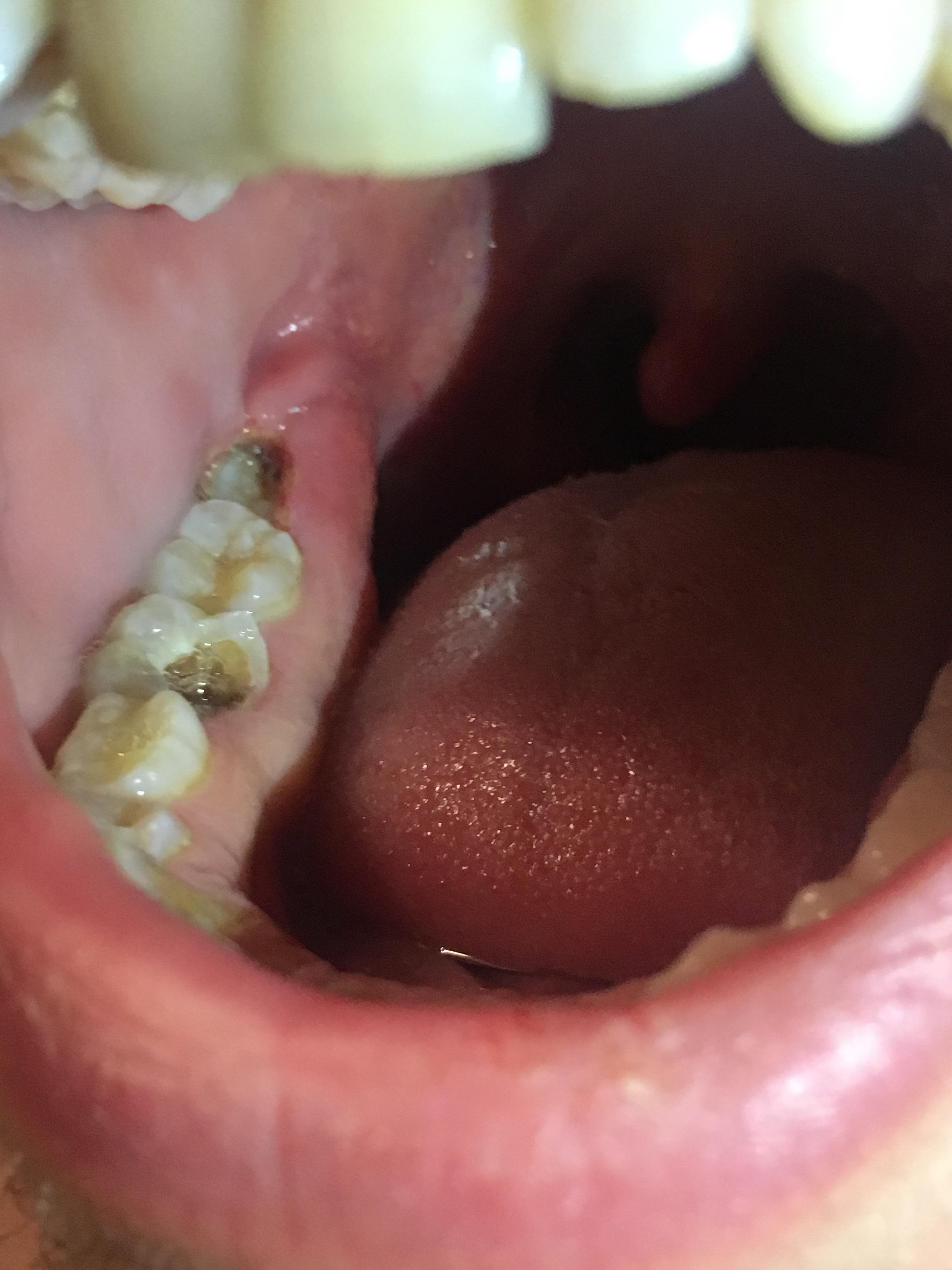 How To Know If I Have A Cavity Reddit Ask Me Anything Some Of Reddit