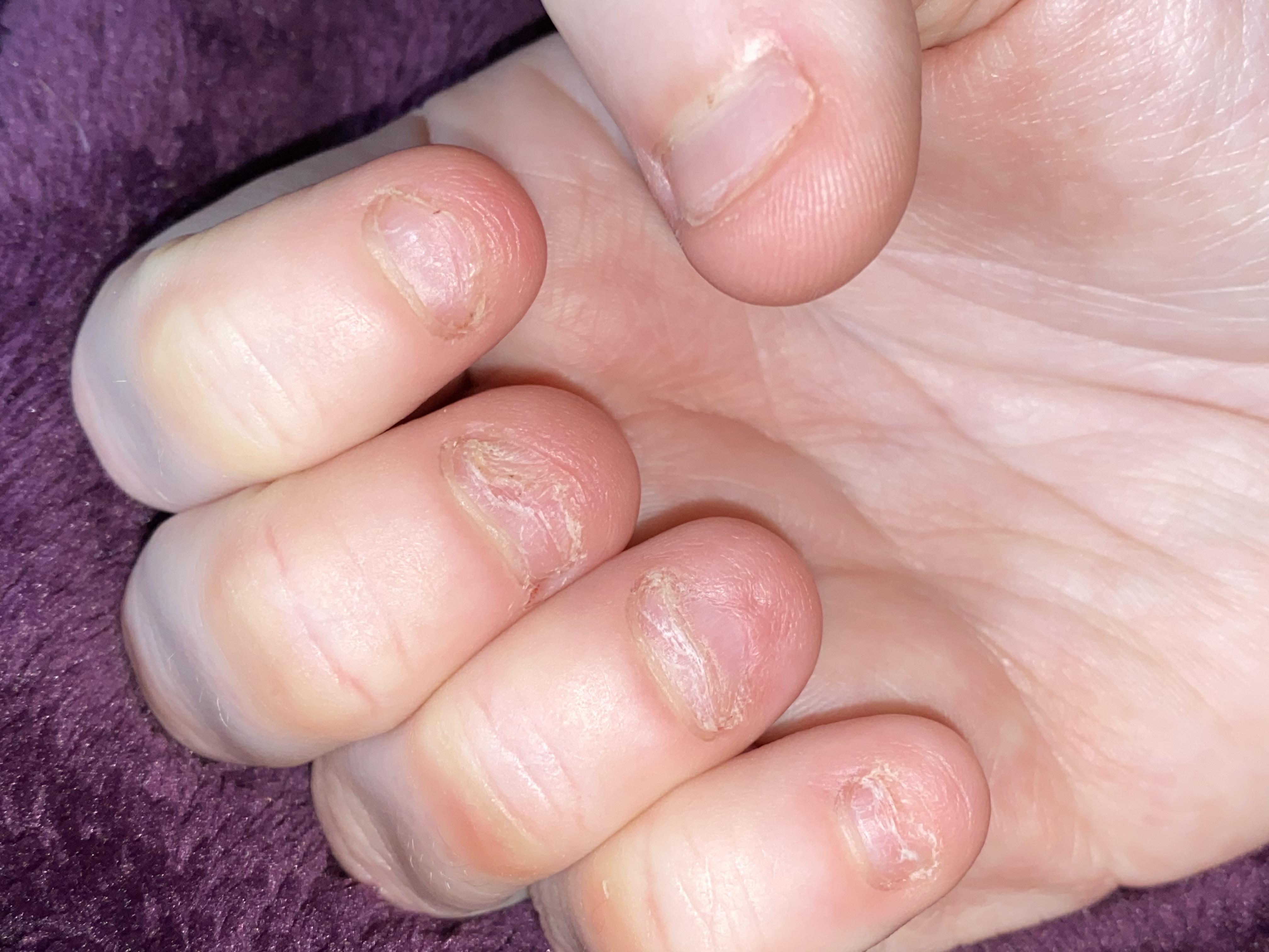 i feel like my nails are destroyed from 20 years of biting and never