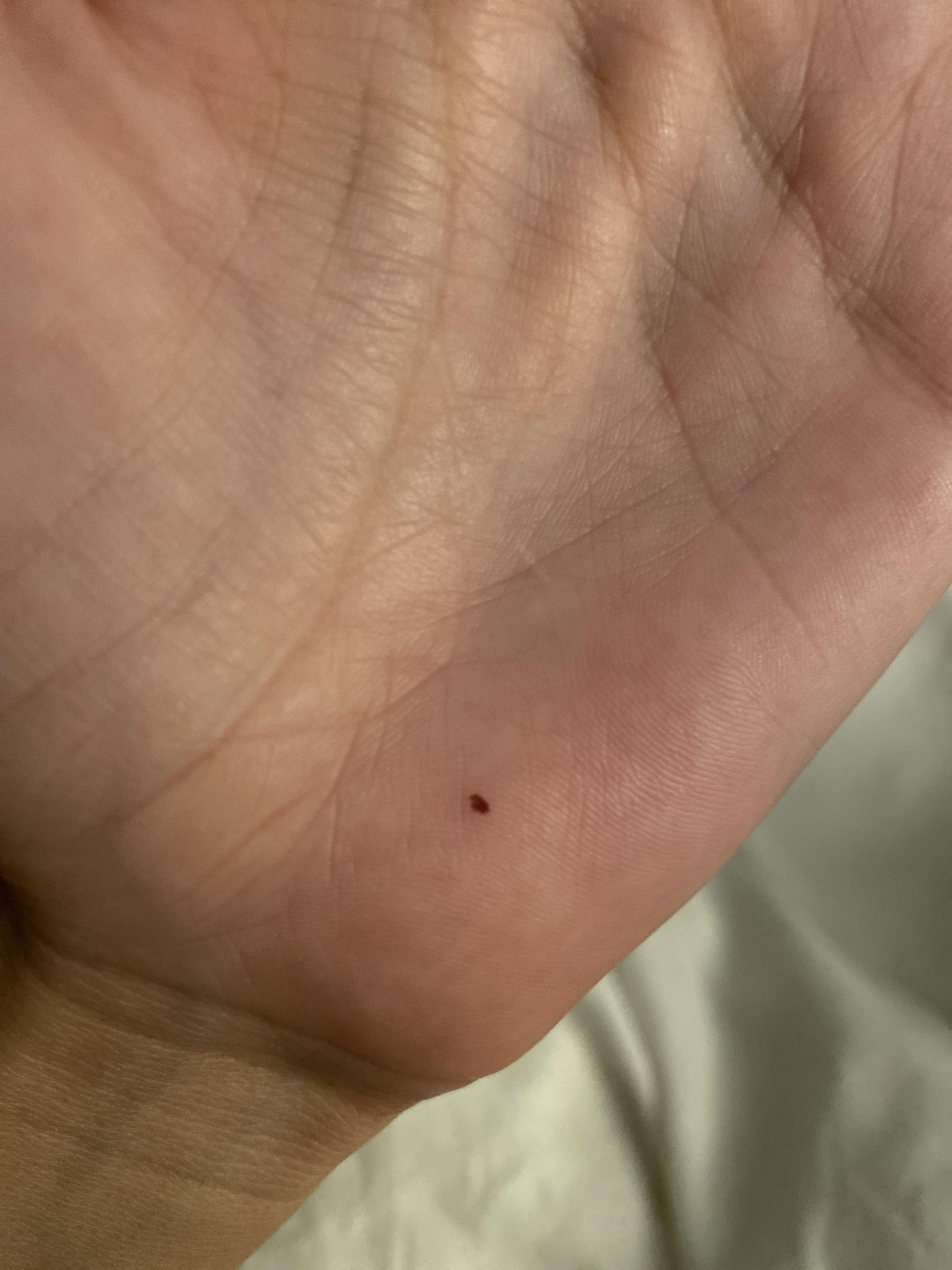 Should i be concerned; i recently have had a new ‘freckle’ appear on