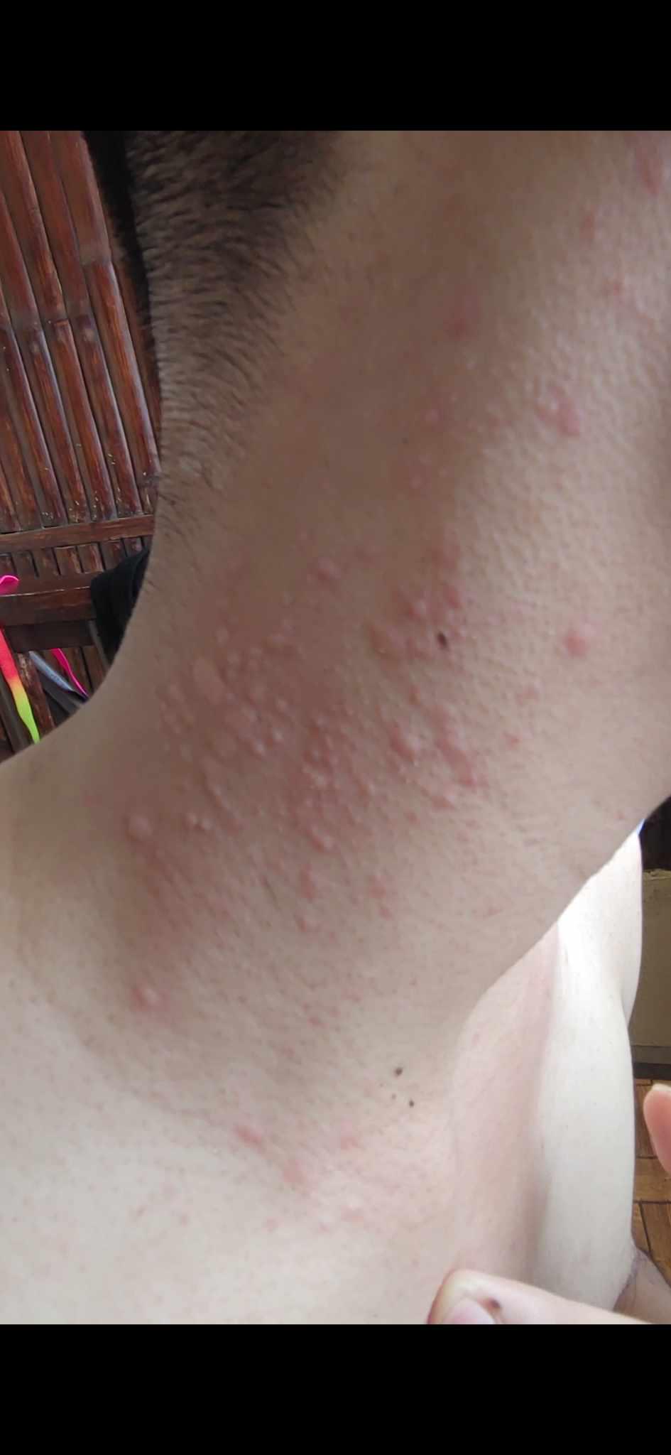 Got hives after swimming in the ocean r/urticaria