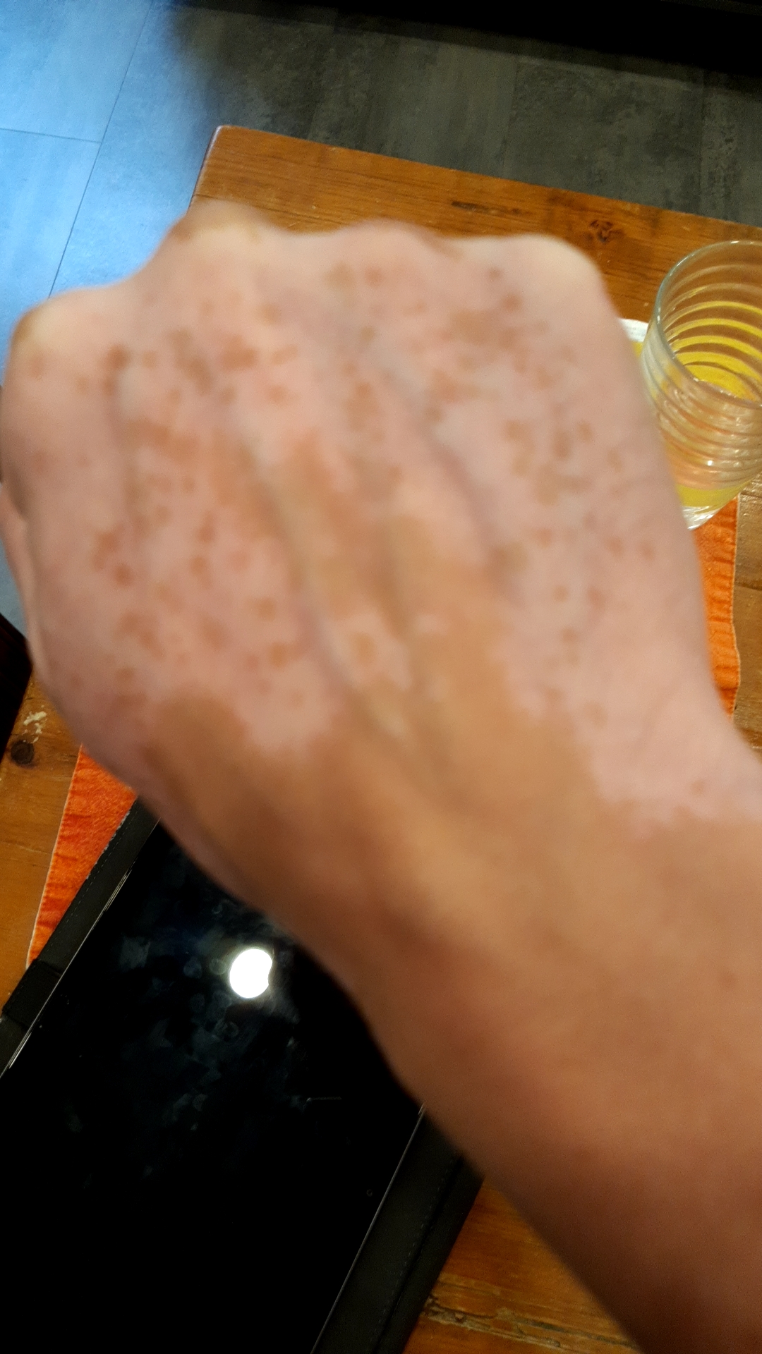 I used to have solid continuous shapes, now I get confetti r/Vitiligo