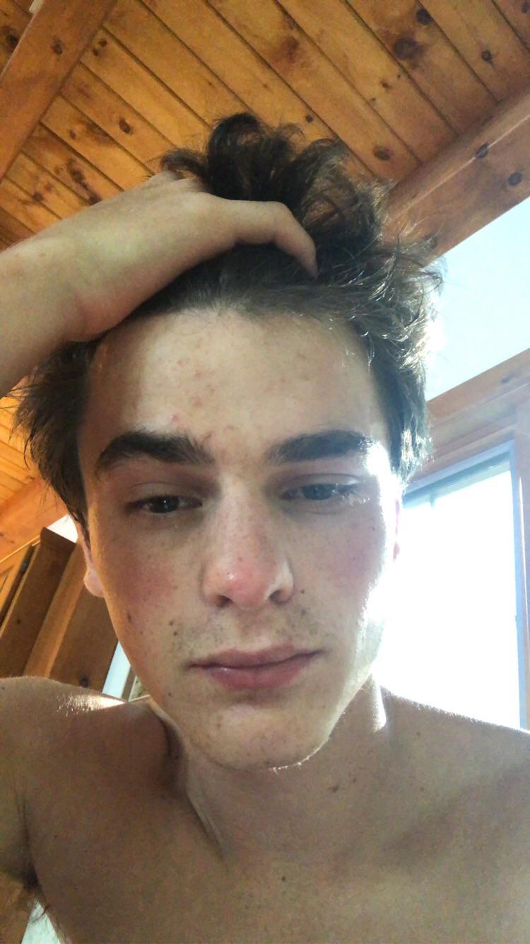 How can I get rid of constant mild acne on forehead? Washing face with