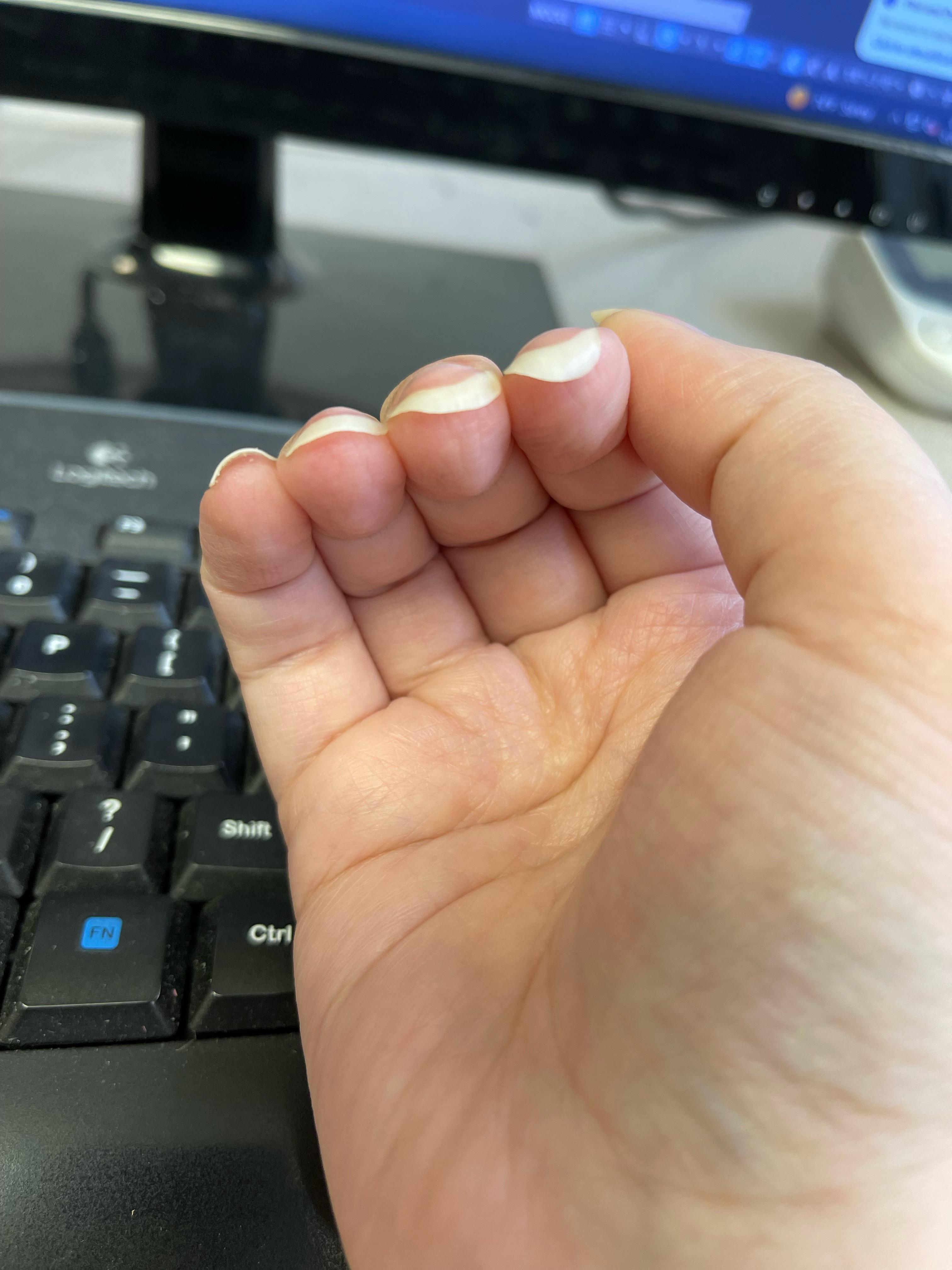 Share more than 138 nail clubbing test best ceg.edu.vn