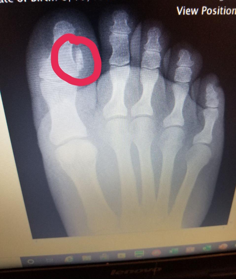 A whole extra bone that also grew nail popping
