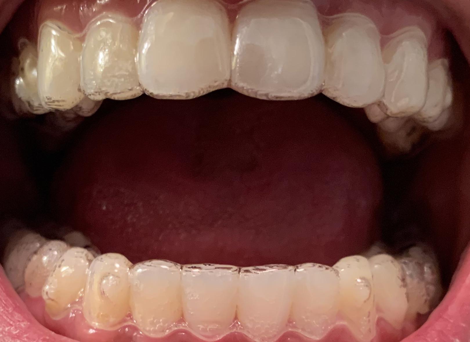 Invisalign Trays Don’t Feel Tight? Here’s How to Fix It