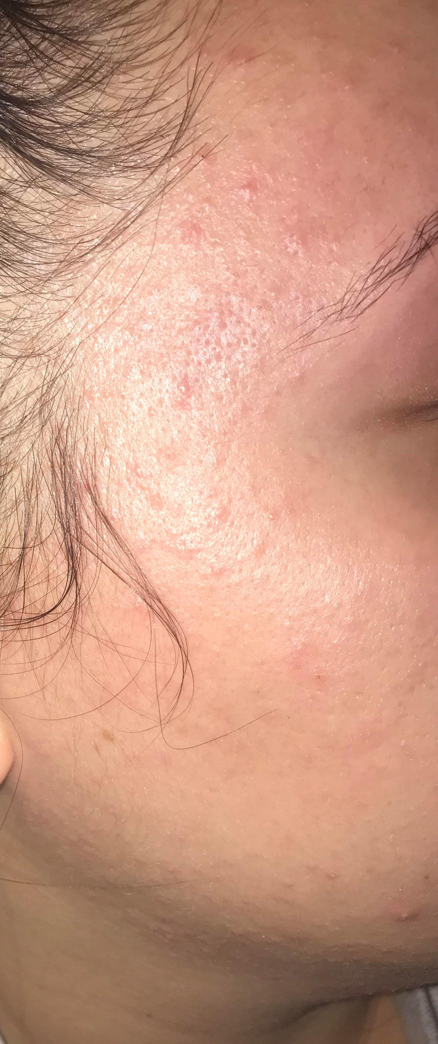 [Skin Concern] Itchy, burning skin r/SkincareAddiction