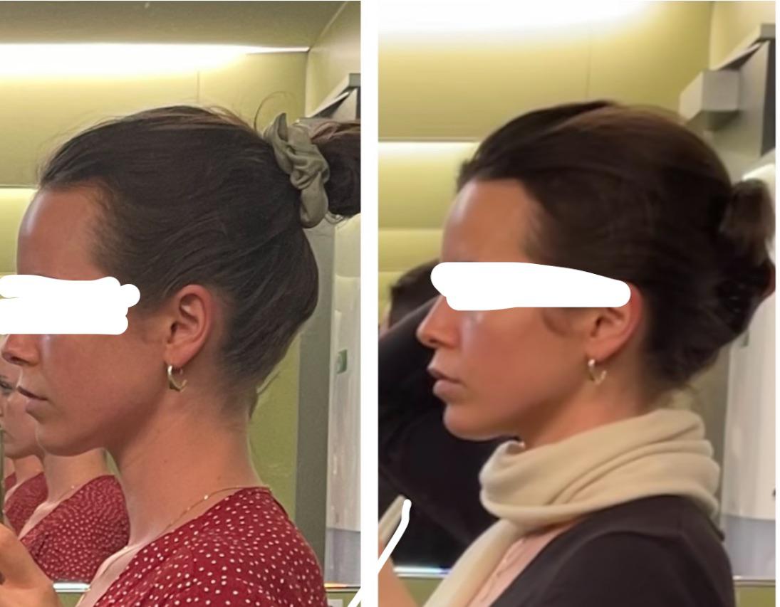 1490 best r/orthotropics images on Pholder Any suggestions to fix my