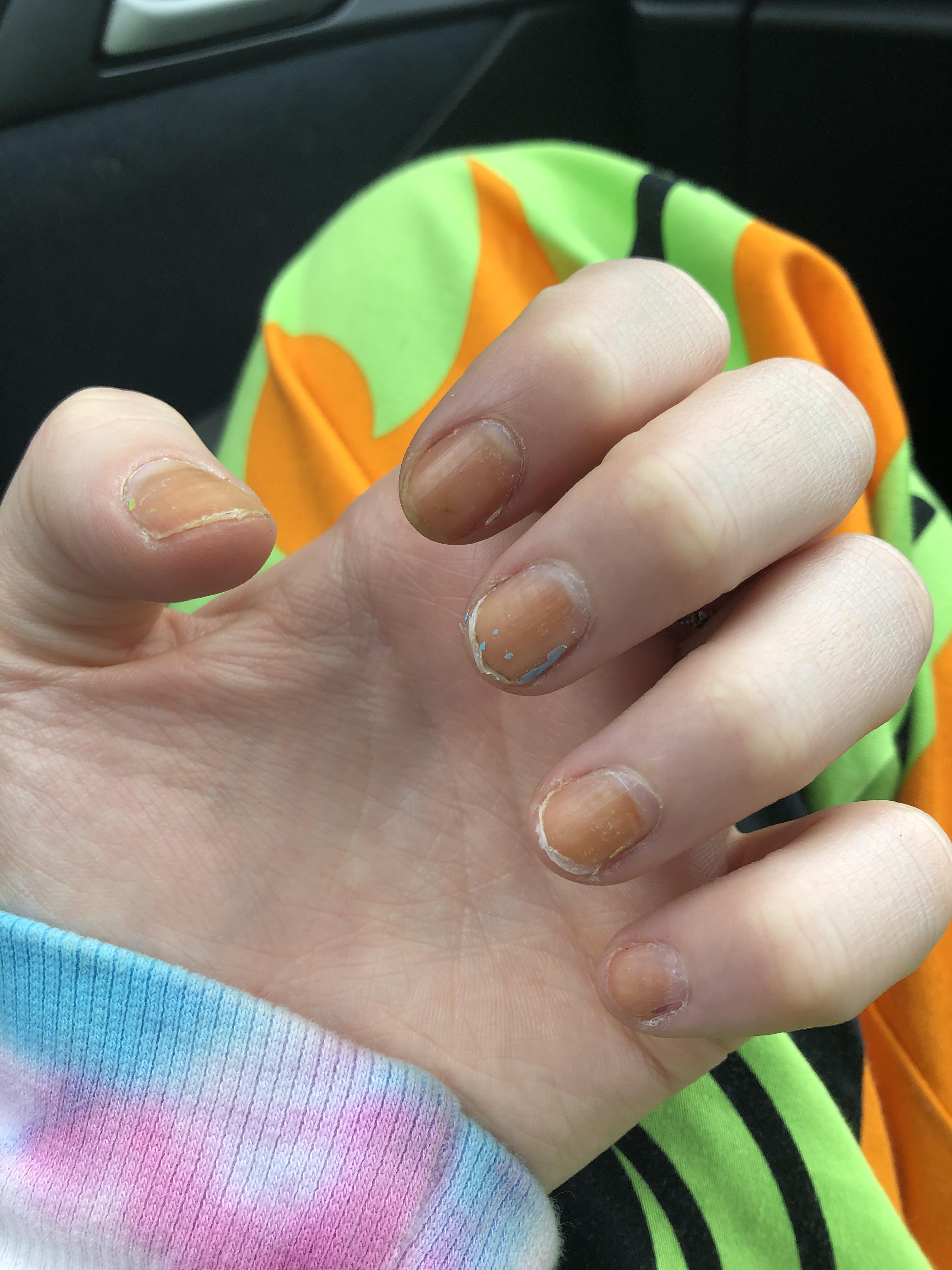 Why are my nails orange in colour? I am worried as some google searches