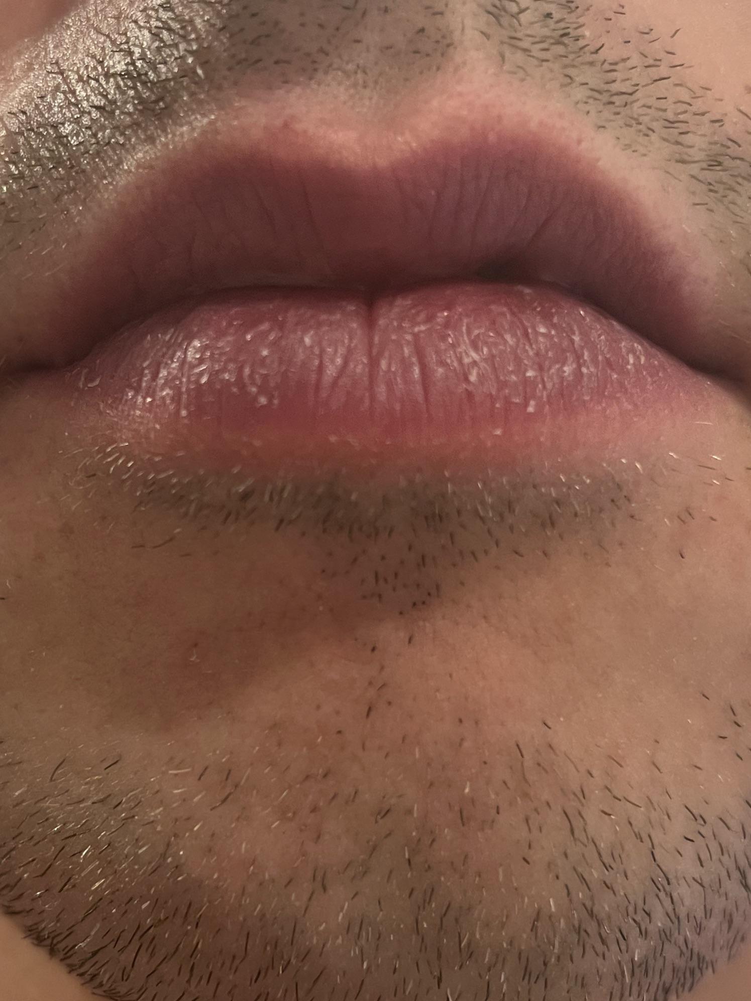 Vermillion Border Of Mouth