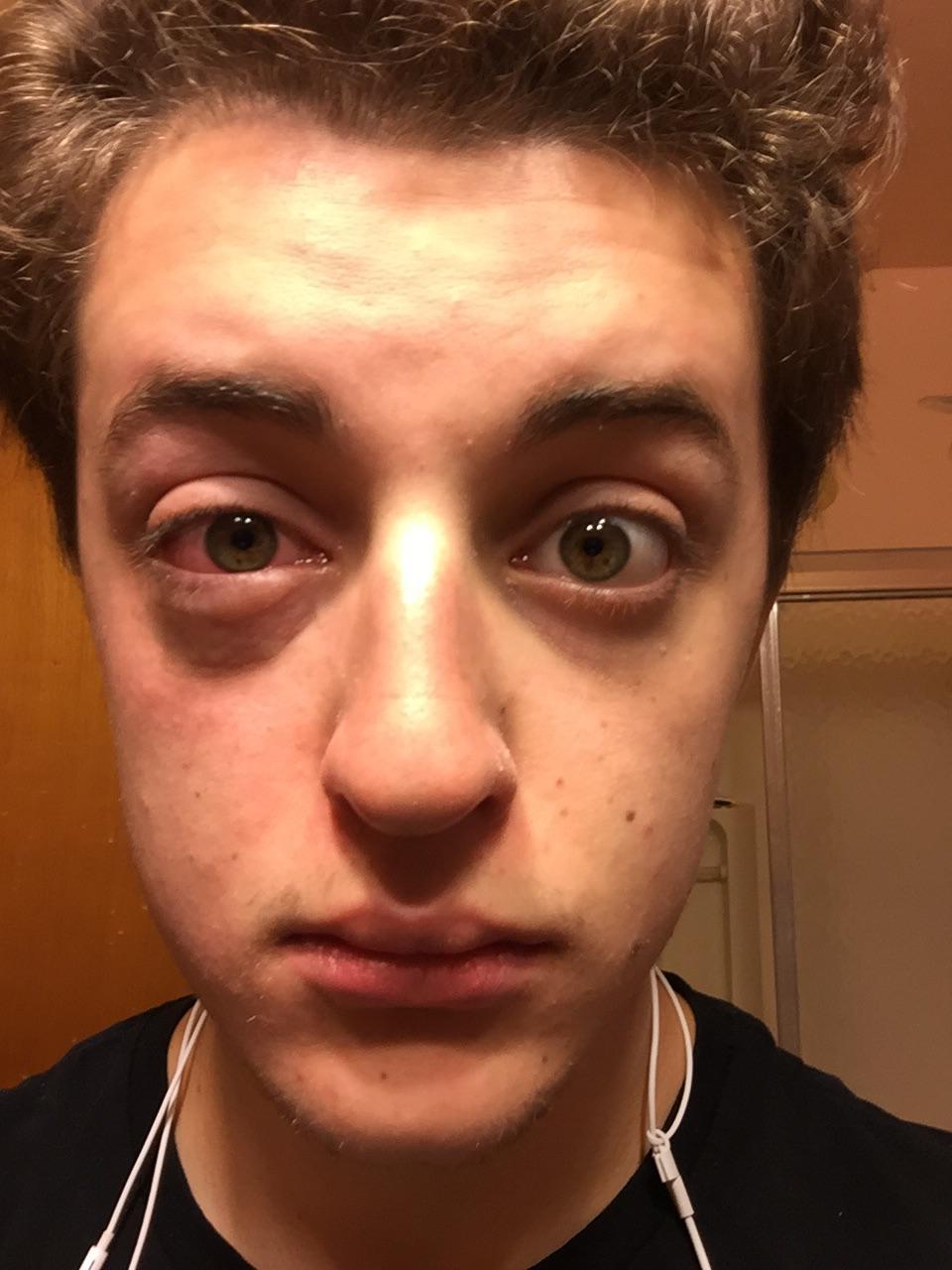 What’s wrong with my eye?? medical
