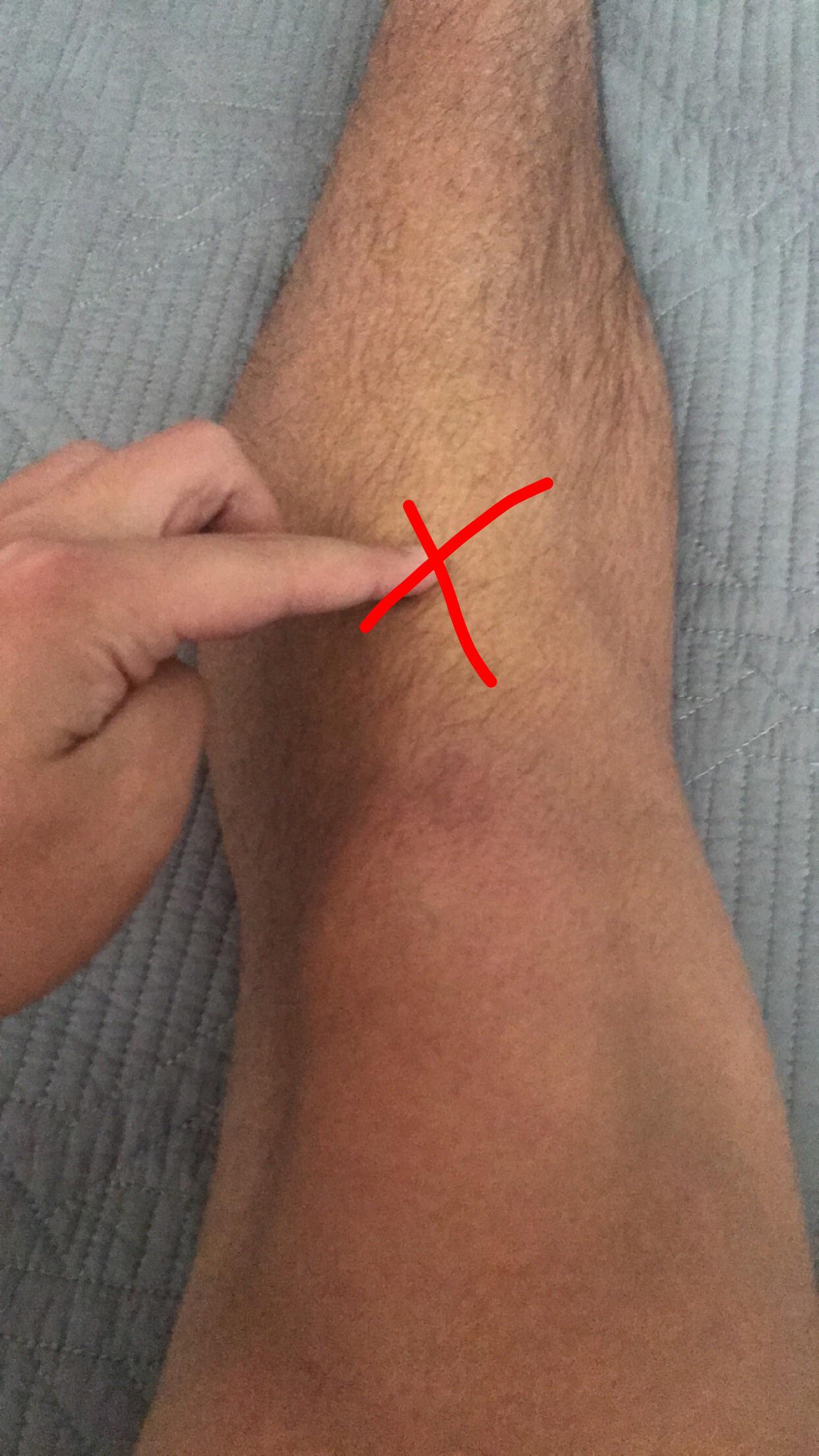 Is this shin splints I experience around that area when