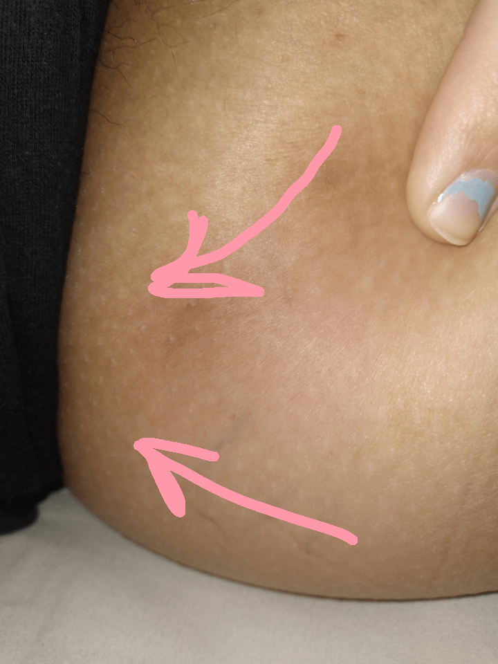 I got these bumps on my bum cheeks after a yeast infection, any help