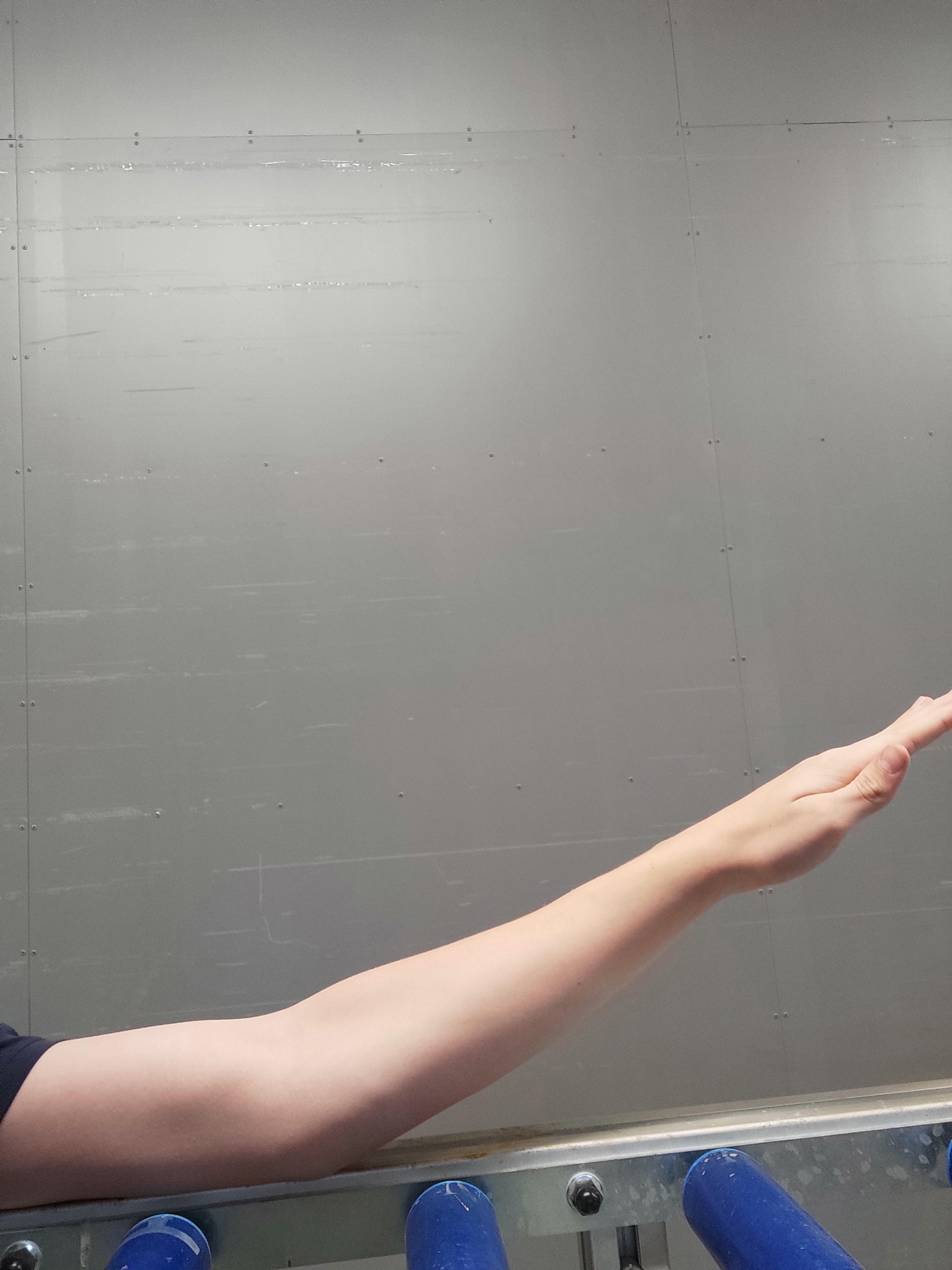 That's my fully extended elbow. I'm pretty sure, that's not normal. Any ideas what could cause