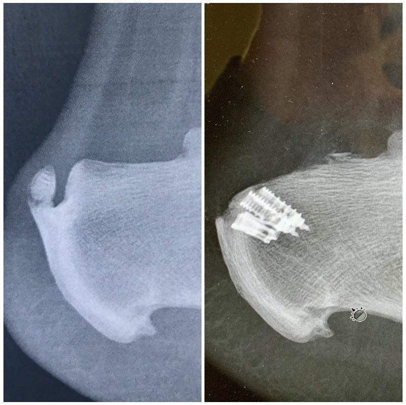Couple of bone spurs removed from my ankle. Achilles had