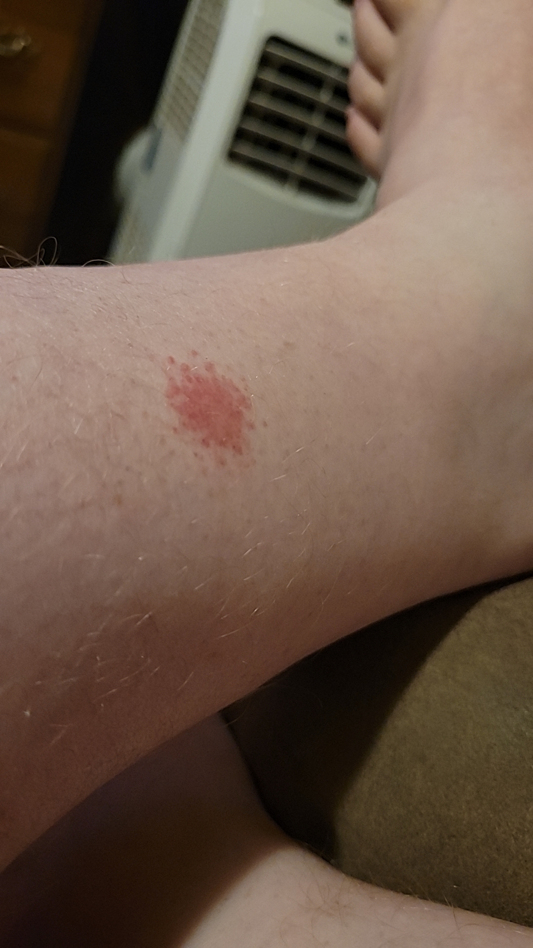 red spot on leg, not itchy or sensitive just...red r/DiagnoseMe