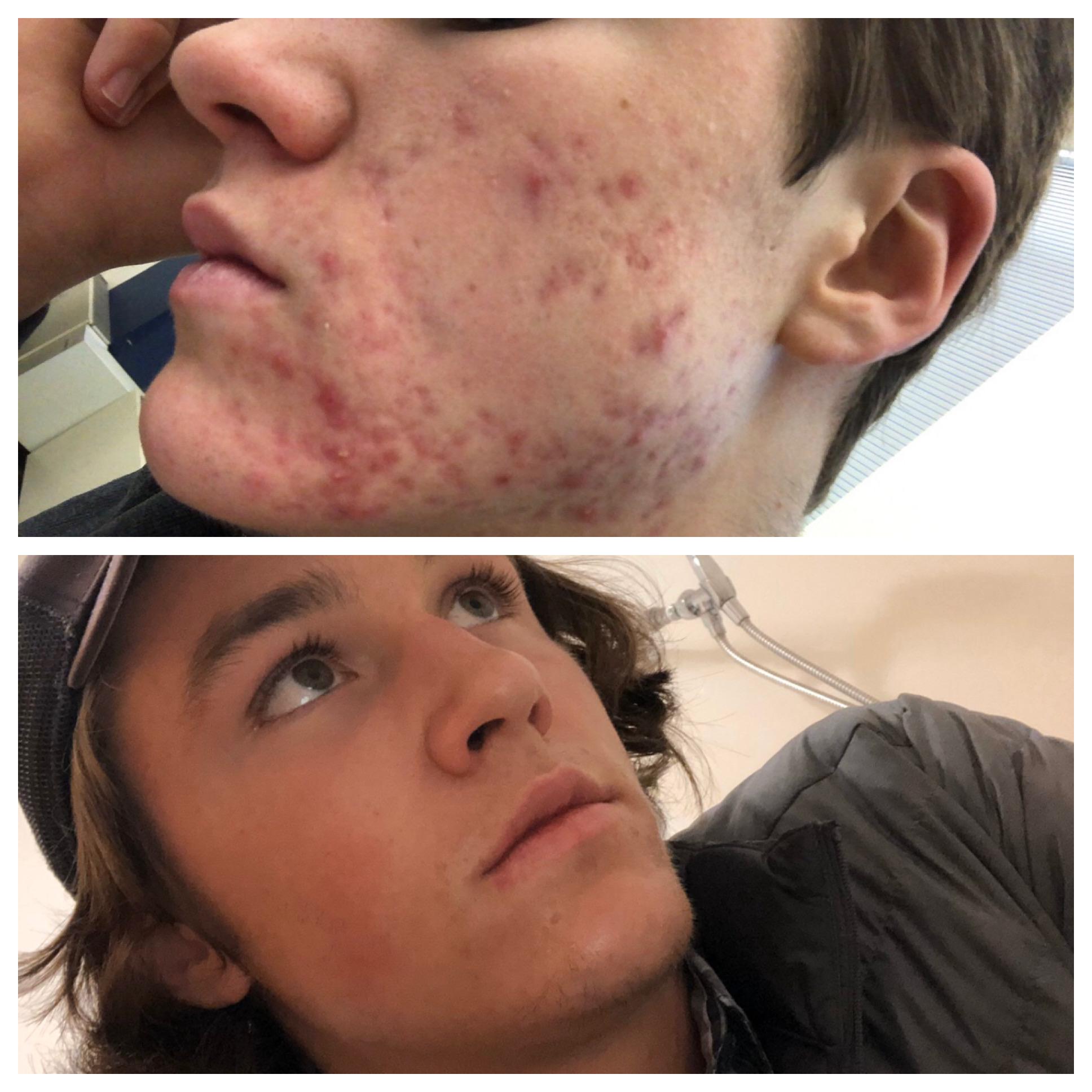 6 months of Epiduo and 6 more months of zero products and sunlight