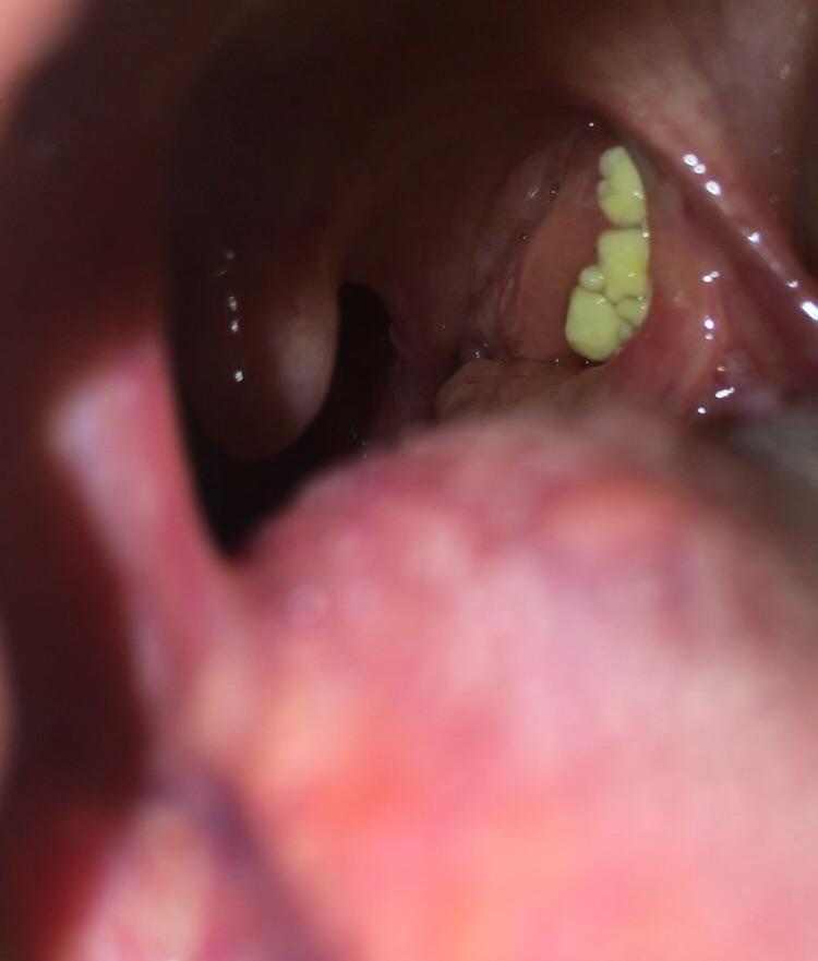 Are these tonsil stones? r/tonsilstones