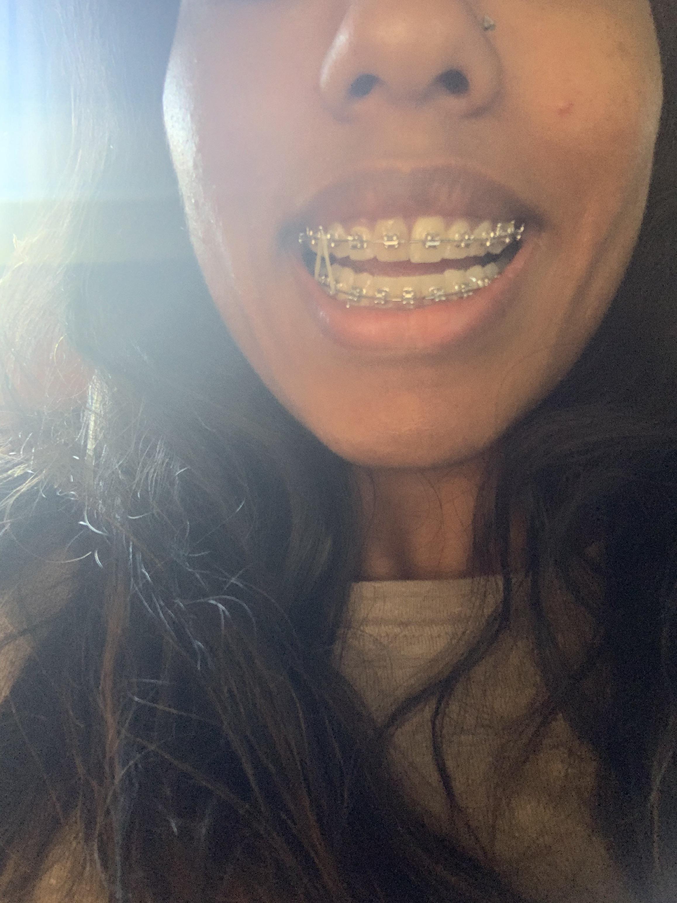 Teeth shaving r/braces