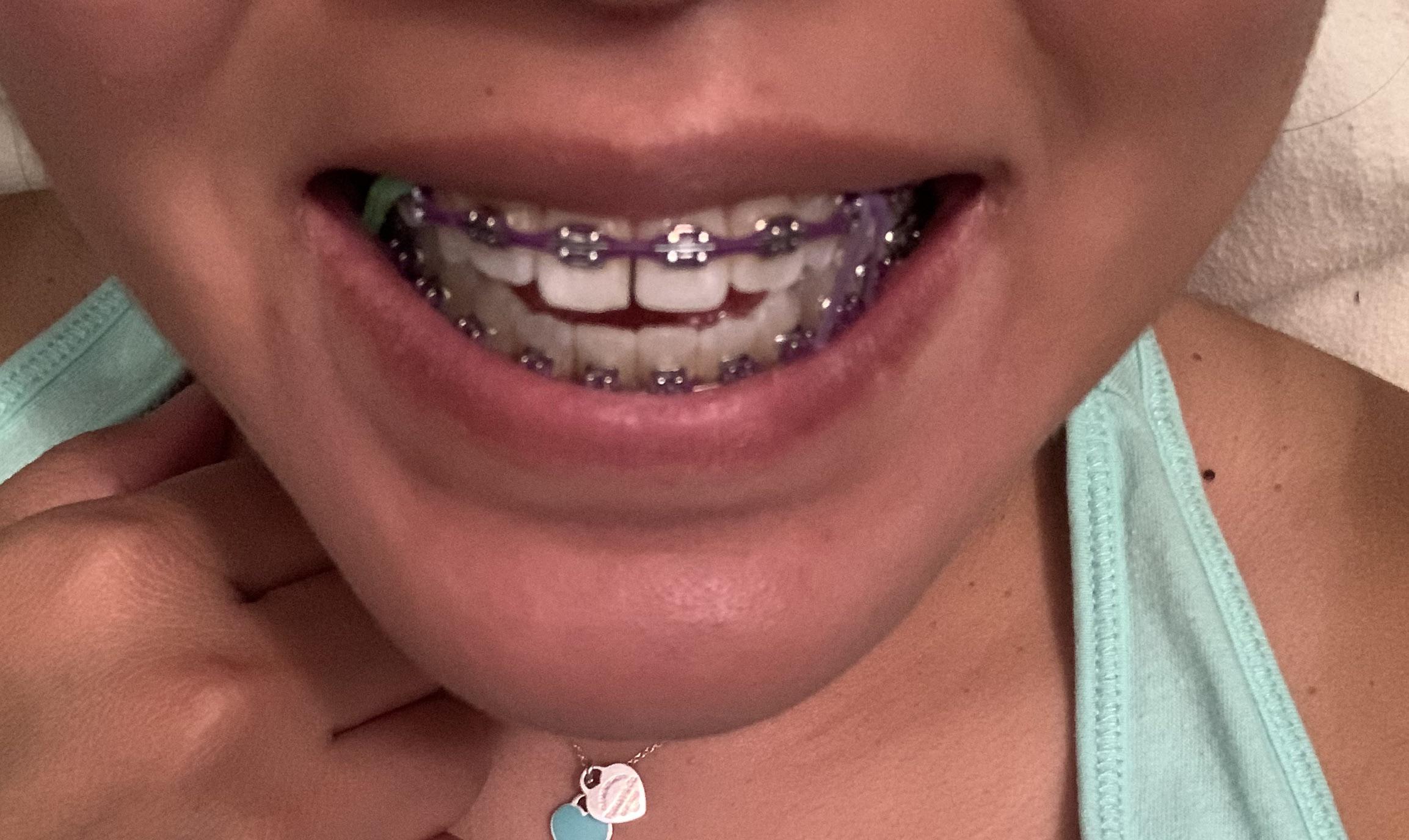 Today I learned that my overjet wasn’t moving so my ortho shaved a gap