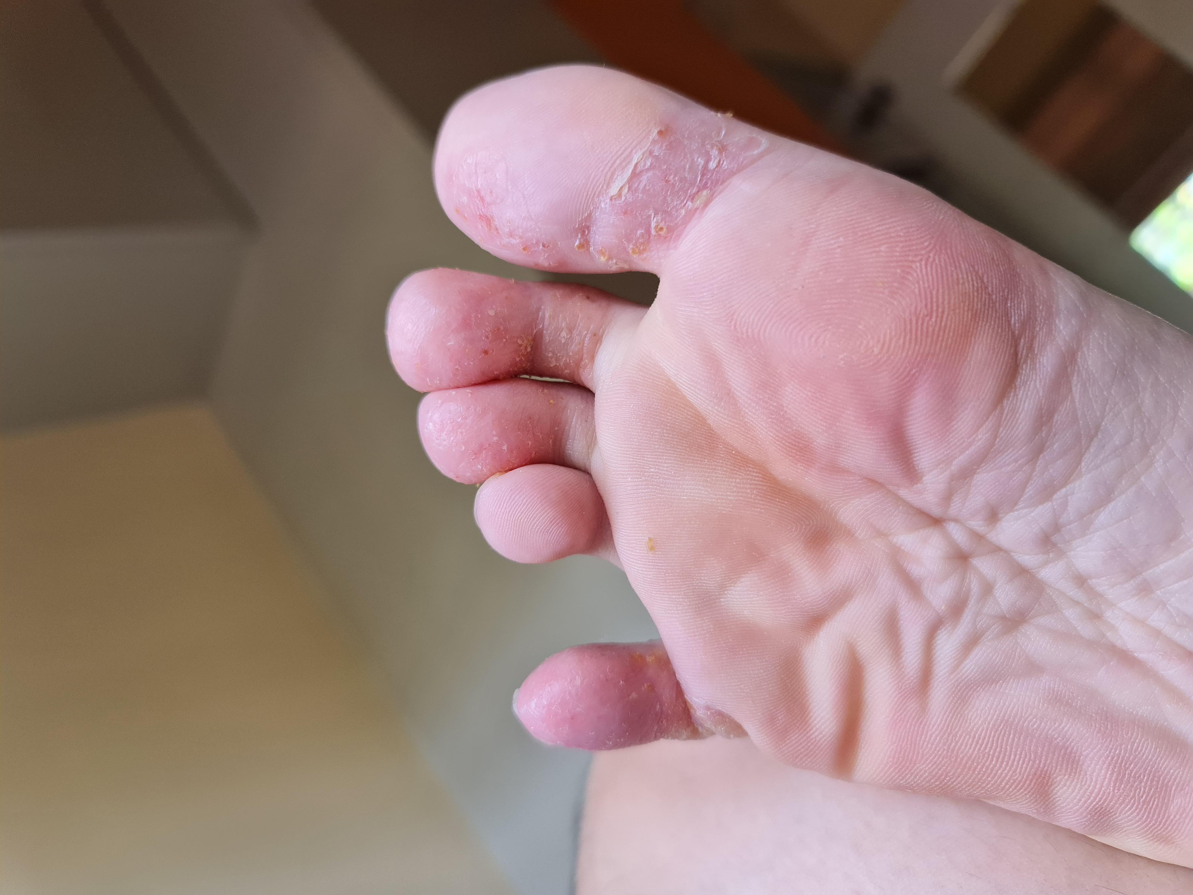 Skin peeling = skin healing? Slowly recovering from dyshidrotic eczema