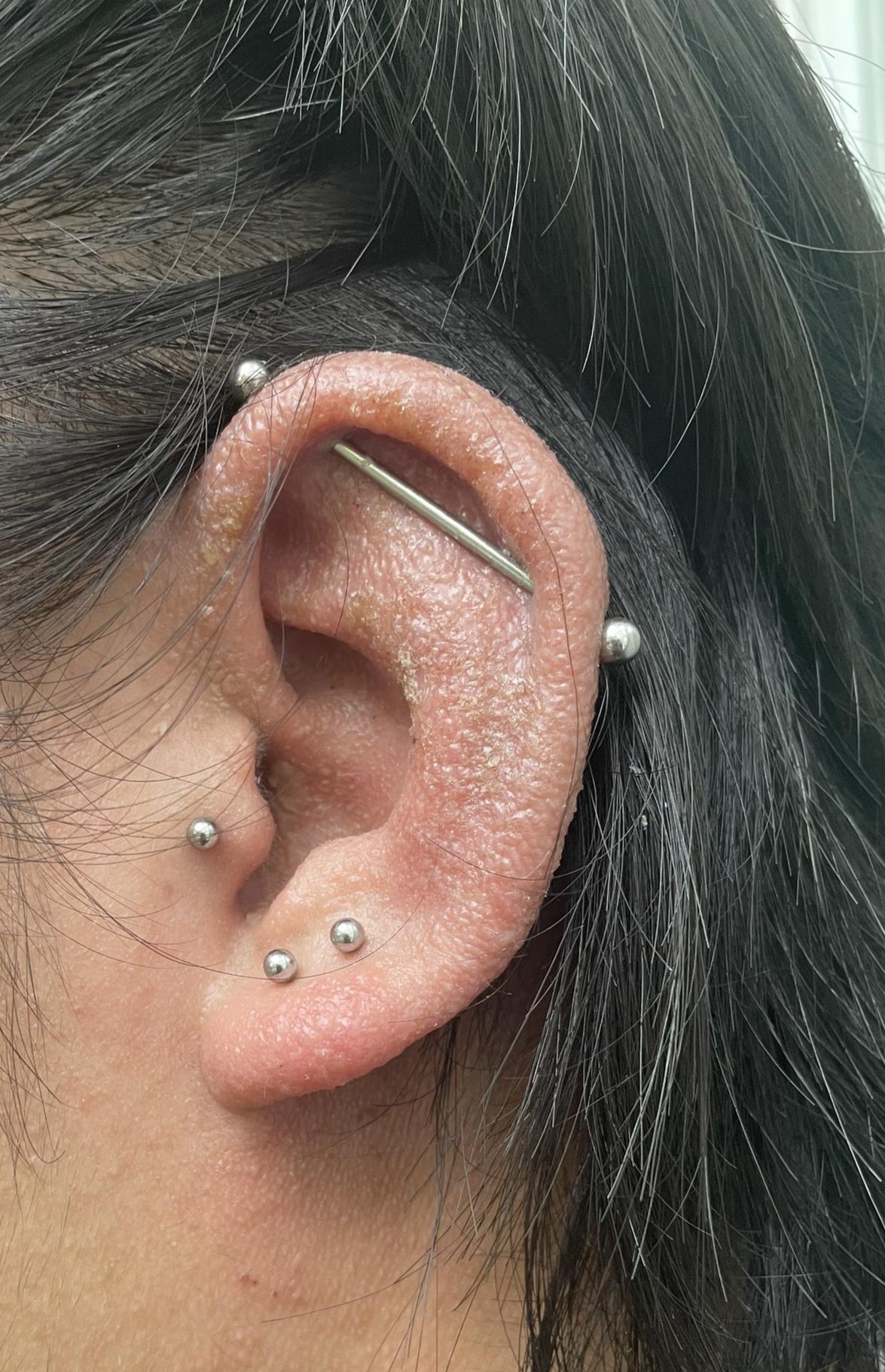 Allergic Reaction Ear Piercing