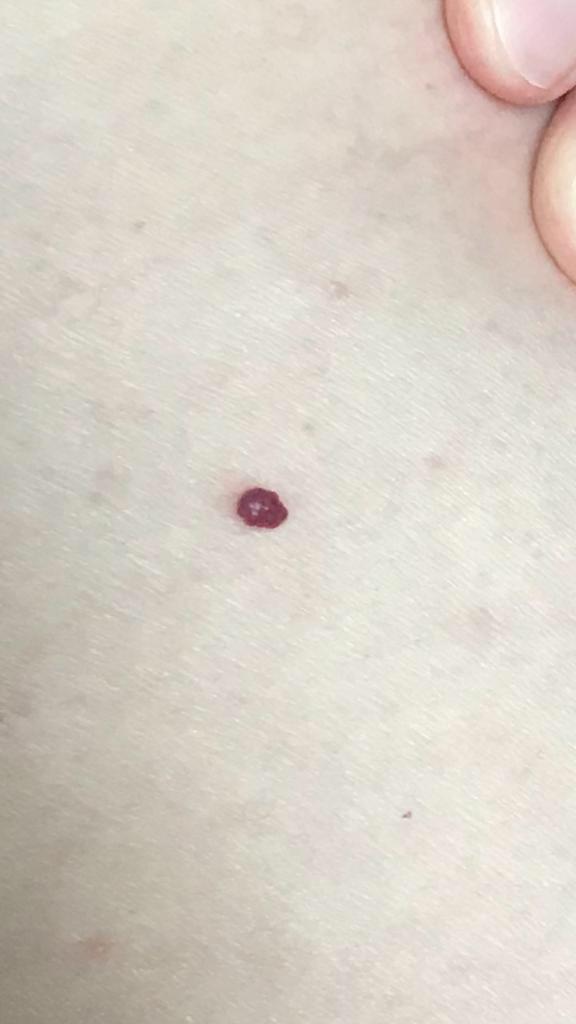 Cherry Angioma Bleeding Reddit Cherry Angioma Nz / They are